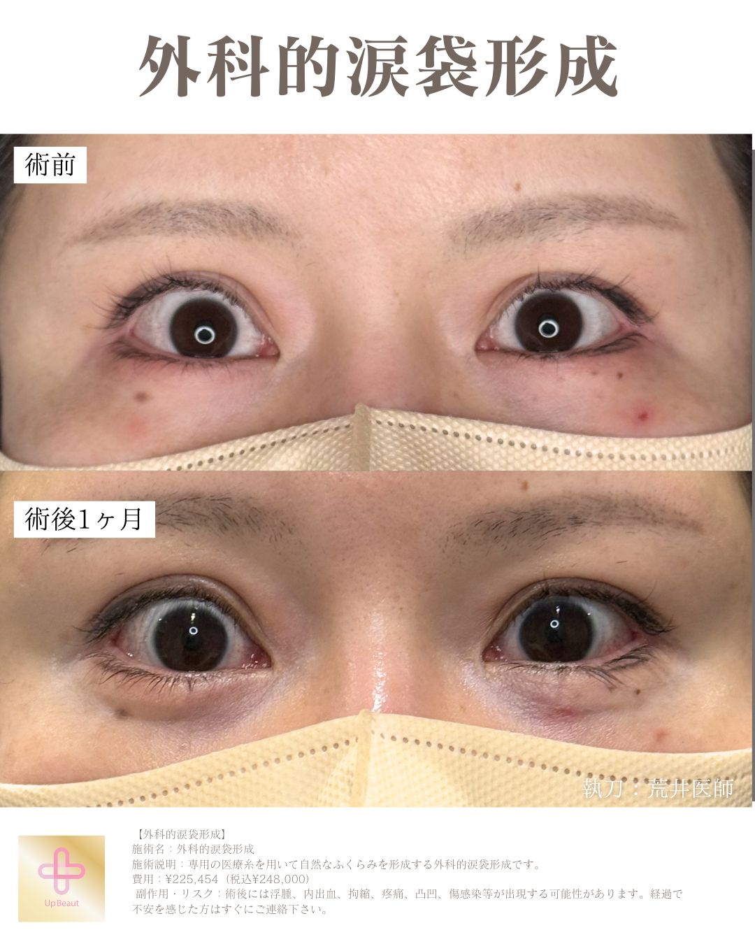 外科的涙袋形成