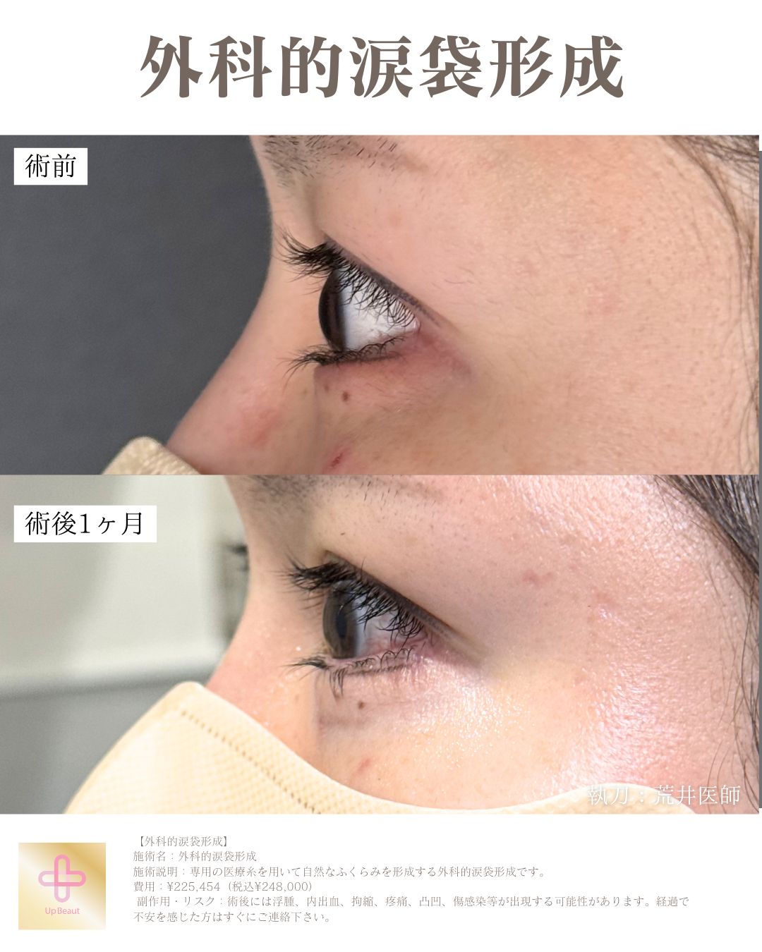 外科的涙袋形成