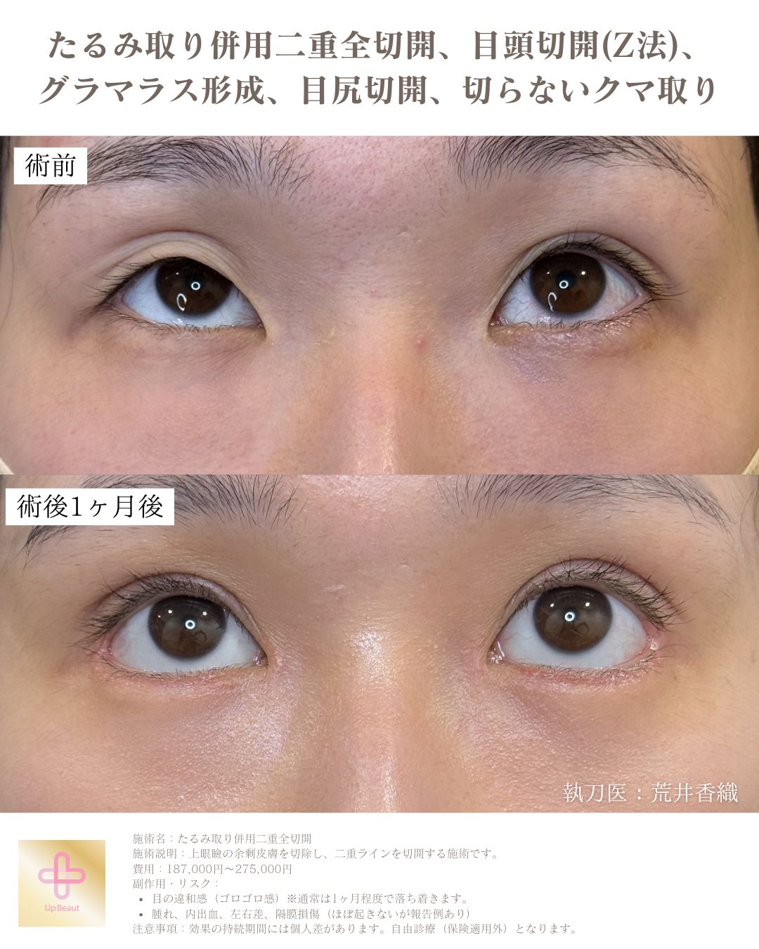 たるみ取り併用二重全切開、目頭切開(Z法) 、グラマラス形成、目尻切開、切らないクマ取り