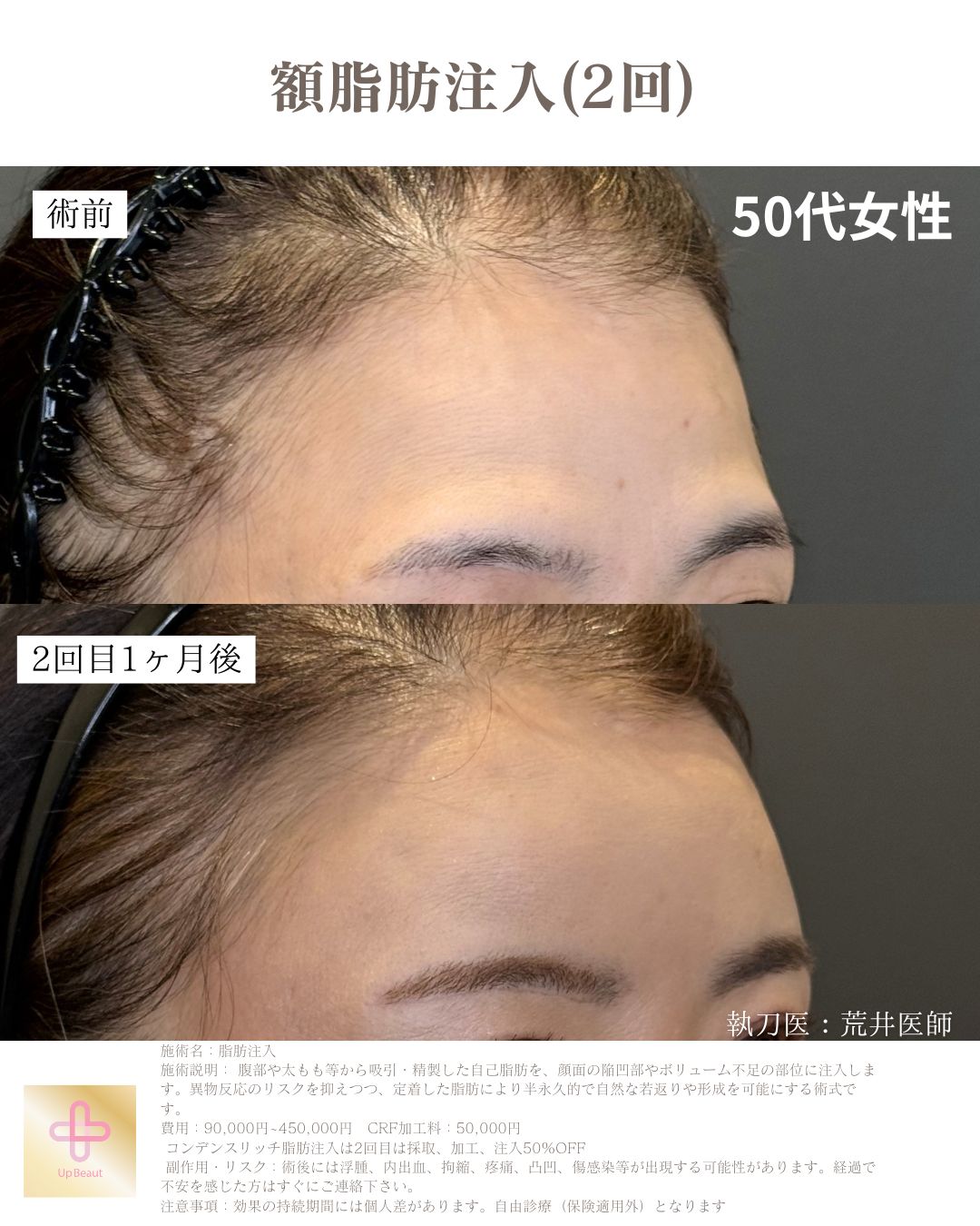 顎下のみ脂肪吸引、ジョールファット、バッカルファット、糸リフト８本、エラボトックス、脂肪注入(ほうれい線１回、額２回)