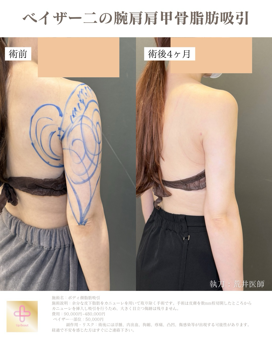 二の腕肩肩甲骨横、副乳脂肪吸引