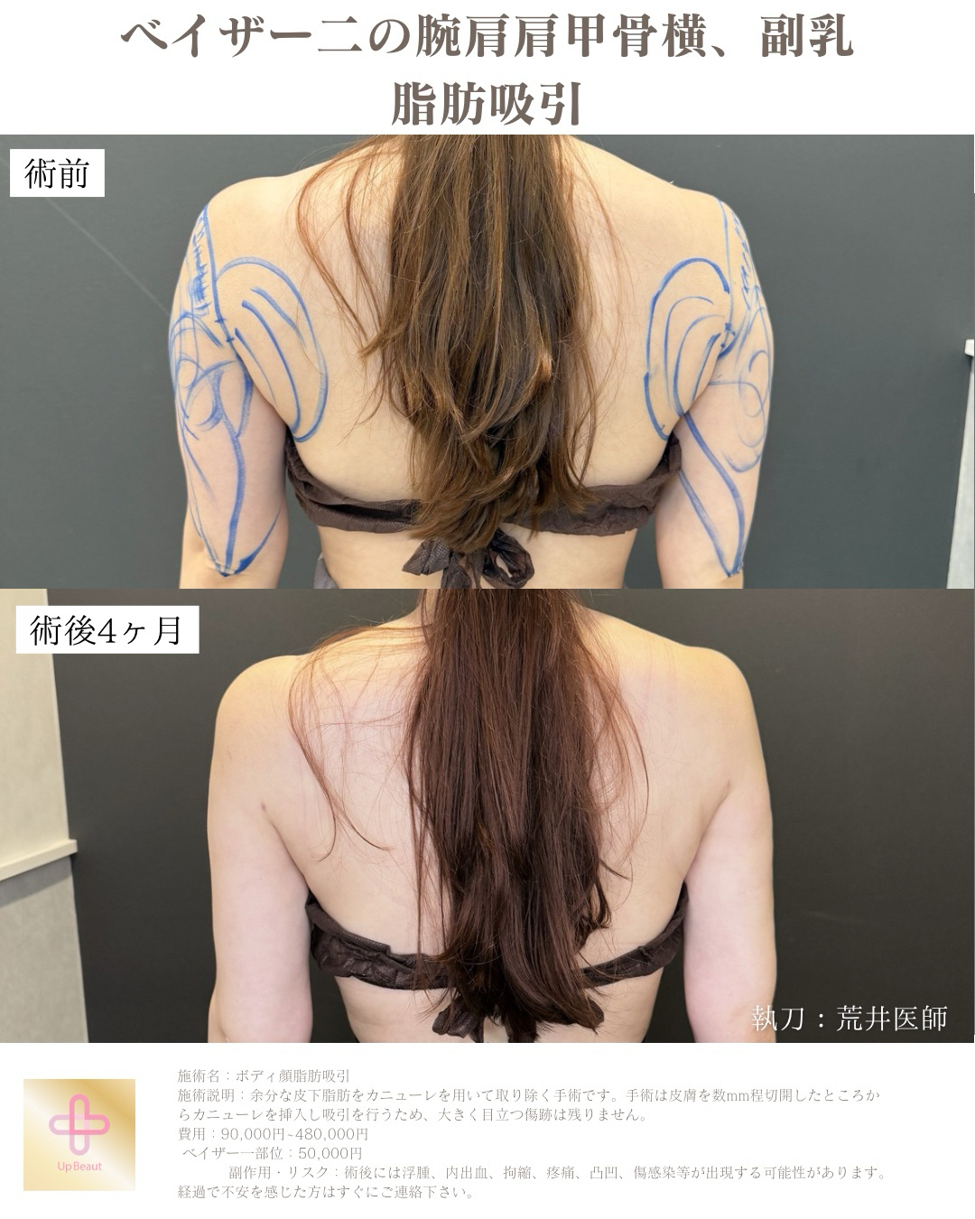 二の腕肩肩甲骨横、副乳脂肪吸引