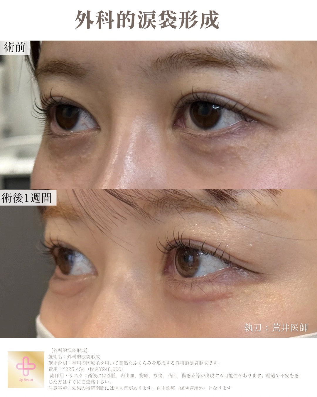 外科的涙袋形成