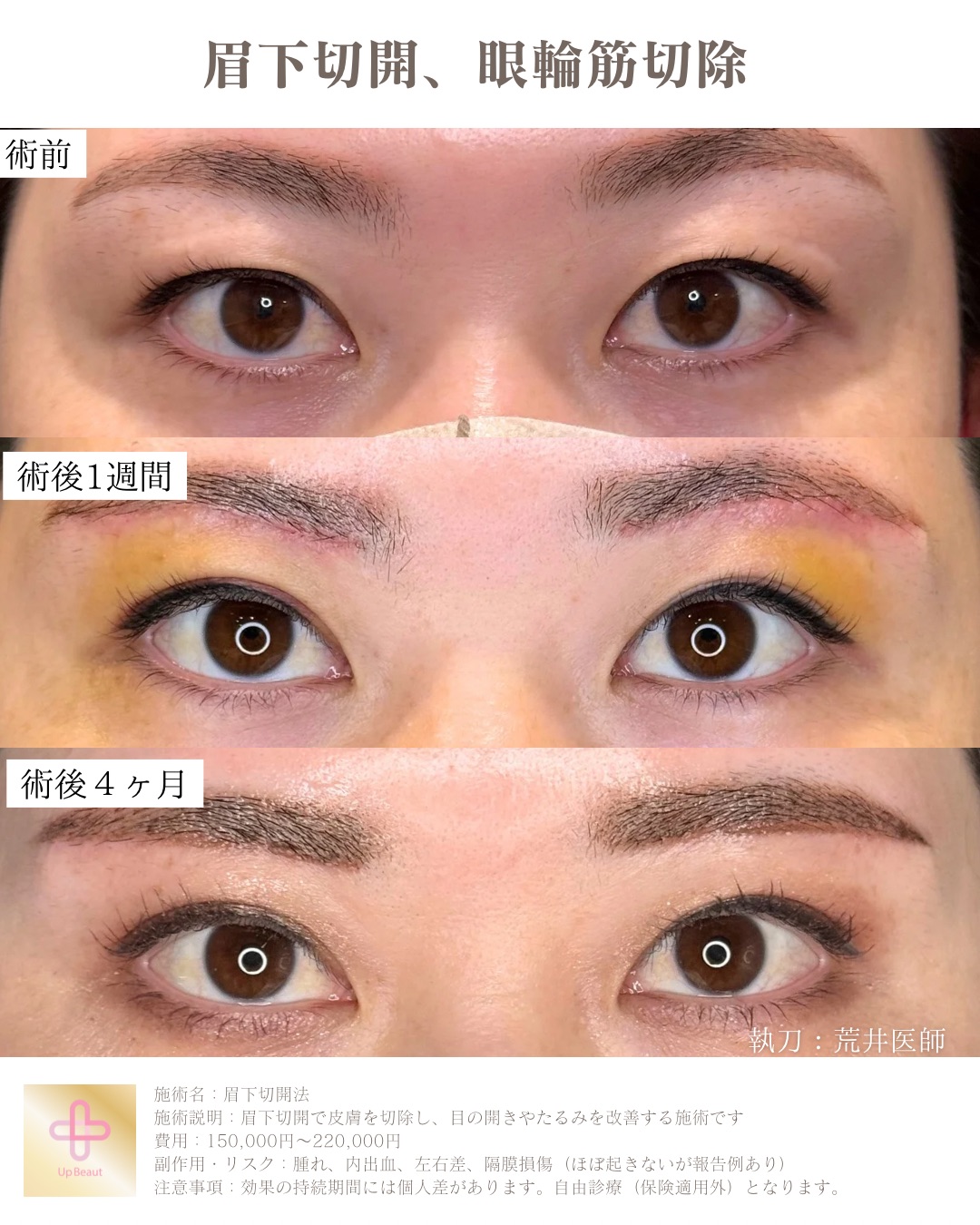 眉下切開、眼輪筋切除