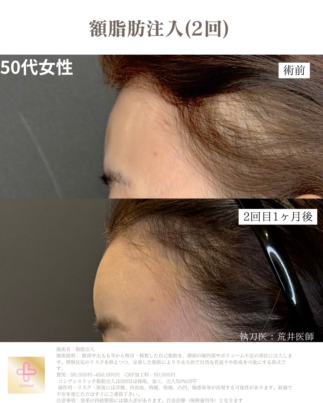 顎下のみ脂肪吸引、ジョールファット、バッカルファット、糸リフト８本、エラボトックス、脂肪注入(ほうれい線１回、額２回)