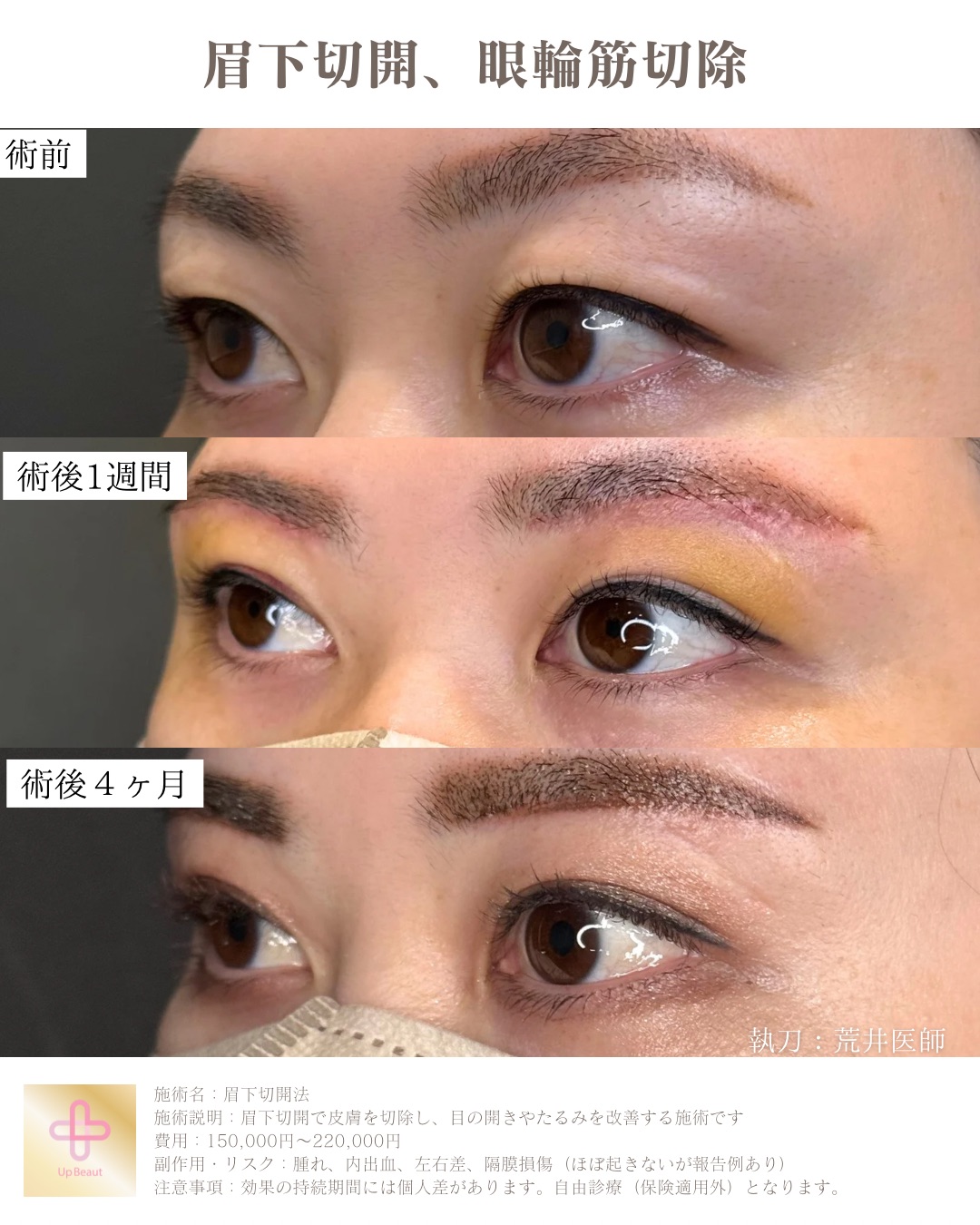 眉下切開、眼輪筋切除