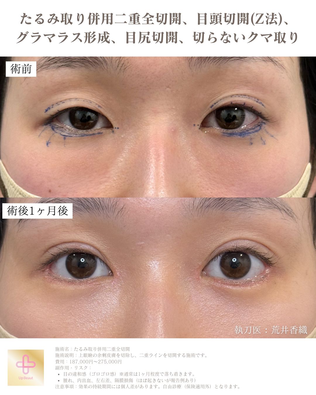 たるみ取り併用二重全切開、目頭切開(Z法) 、グラマラス形成、目尻切開、切らないクマ取り