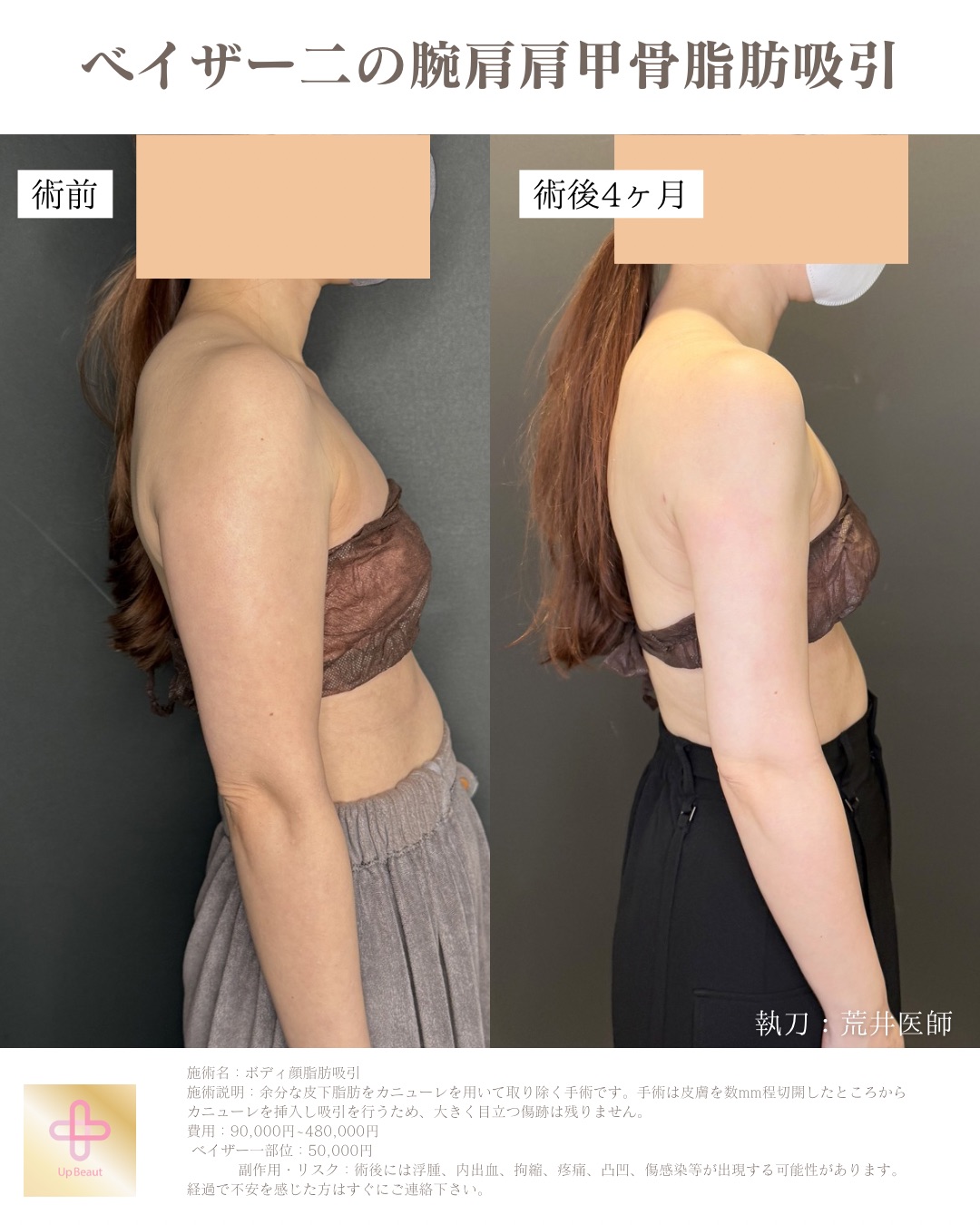 二の腕肩肩甲骨横、副乳脂肪吸引