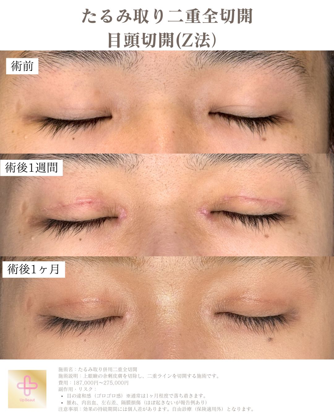 たるみ取り併用全切開二重術、目頭切開(Z法)