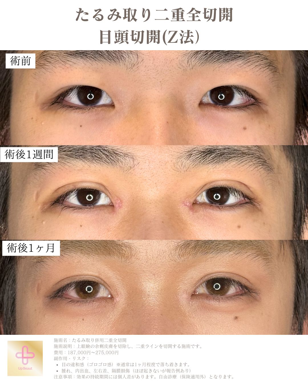 たるみ取り併用全切開二重術、目頭切開(Z法)