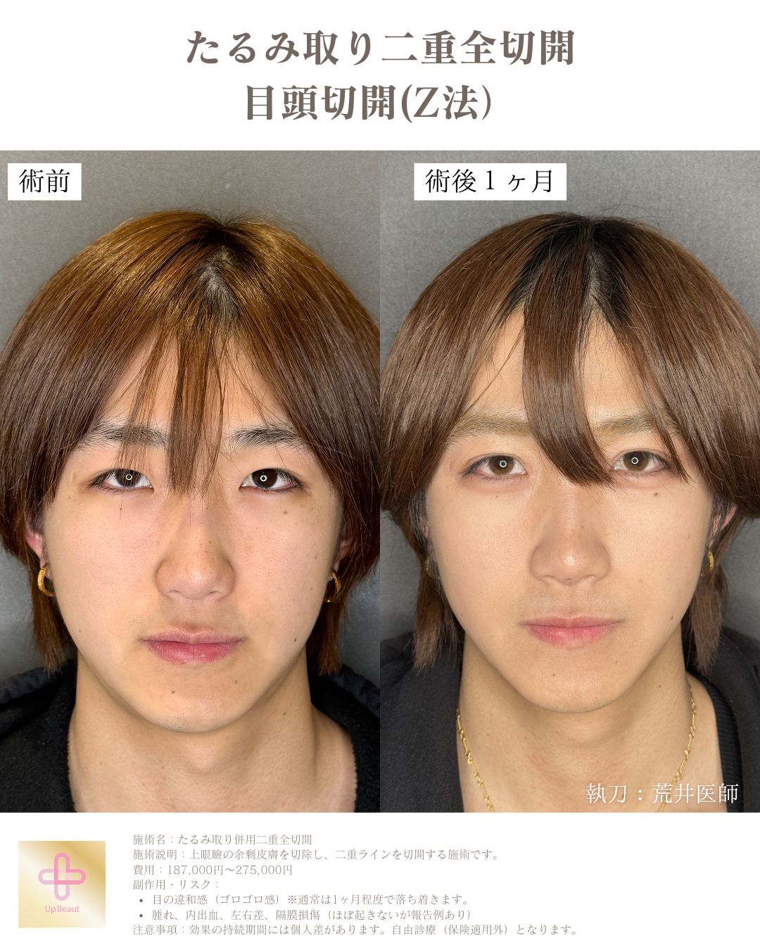 たるみ取り併用全切開二重術、目頭切開(Z法)