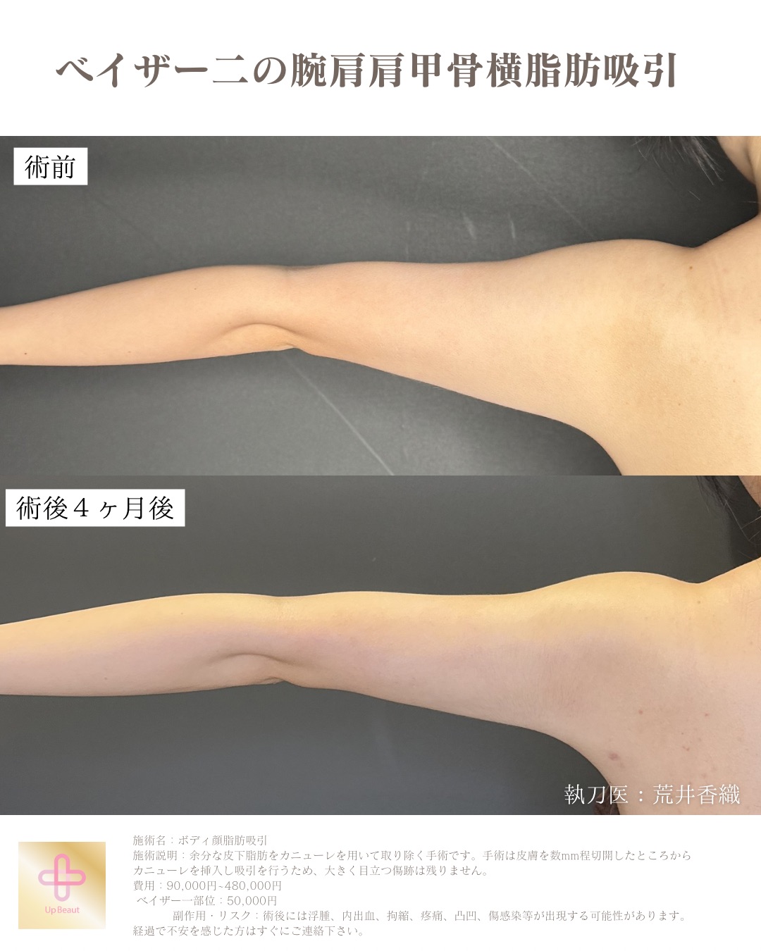 VASER脂肪吸引 引き締め症例2