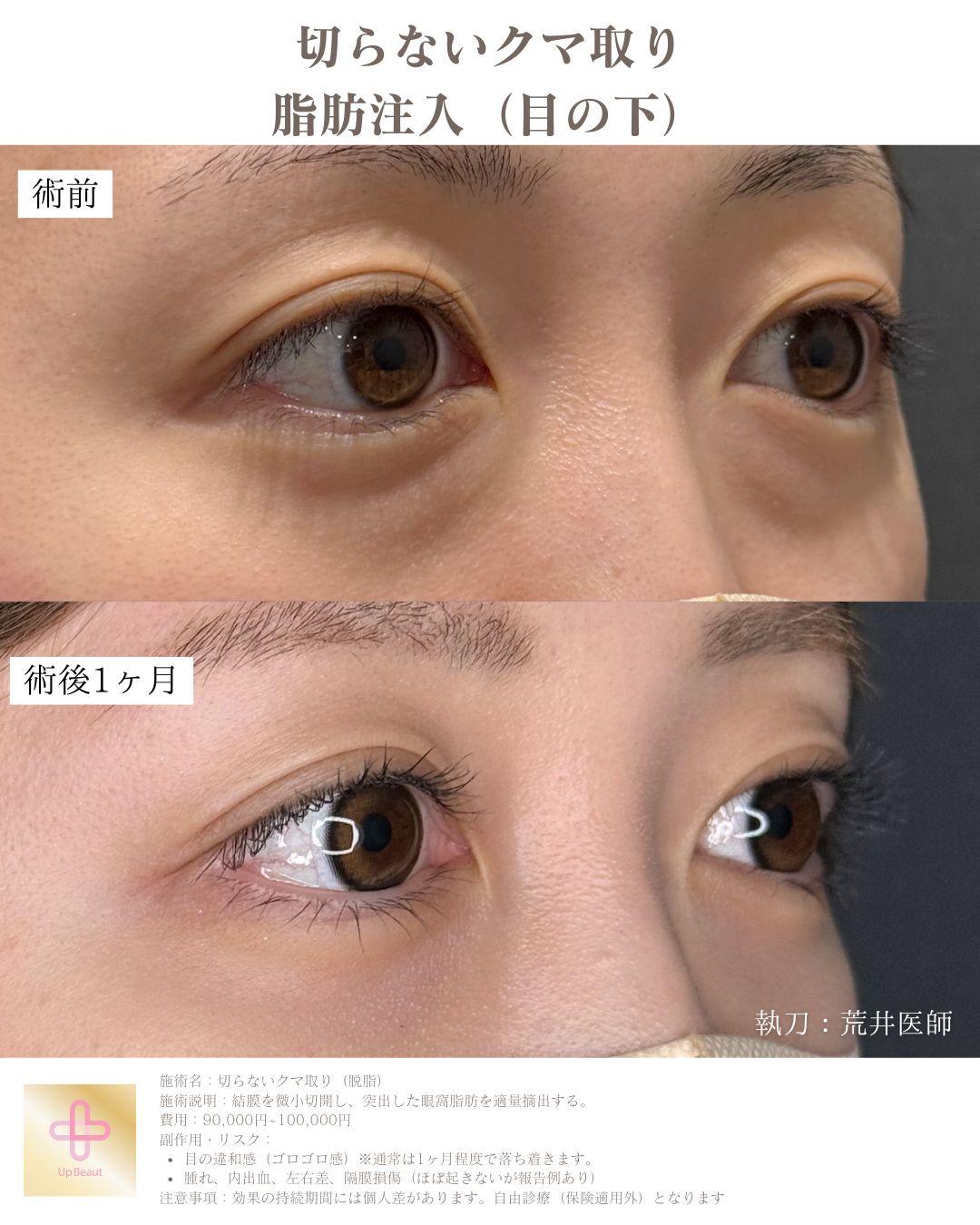 目の下の脱脂、脂肪注入（目の下）