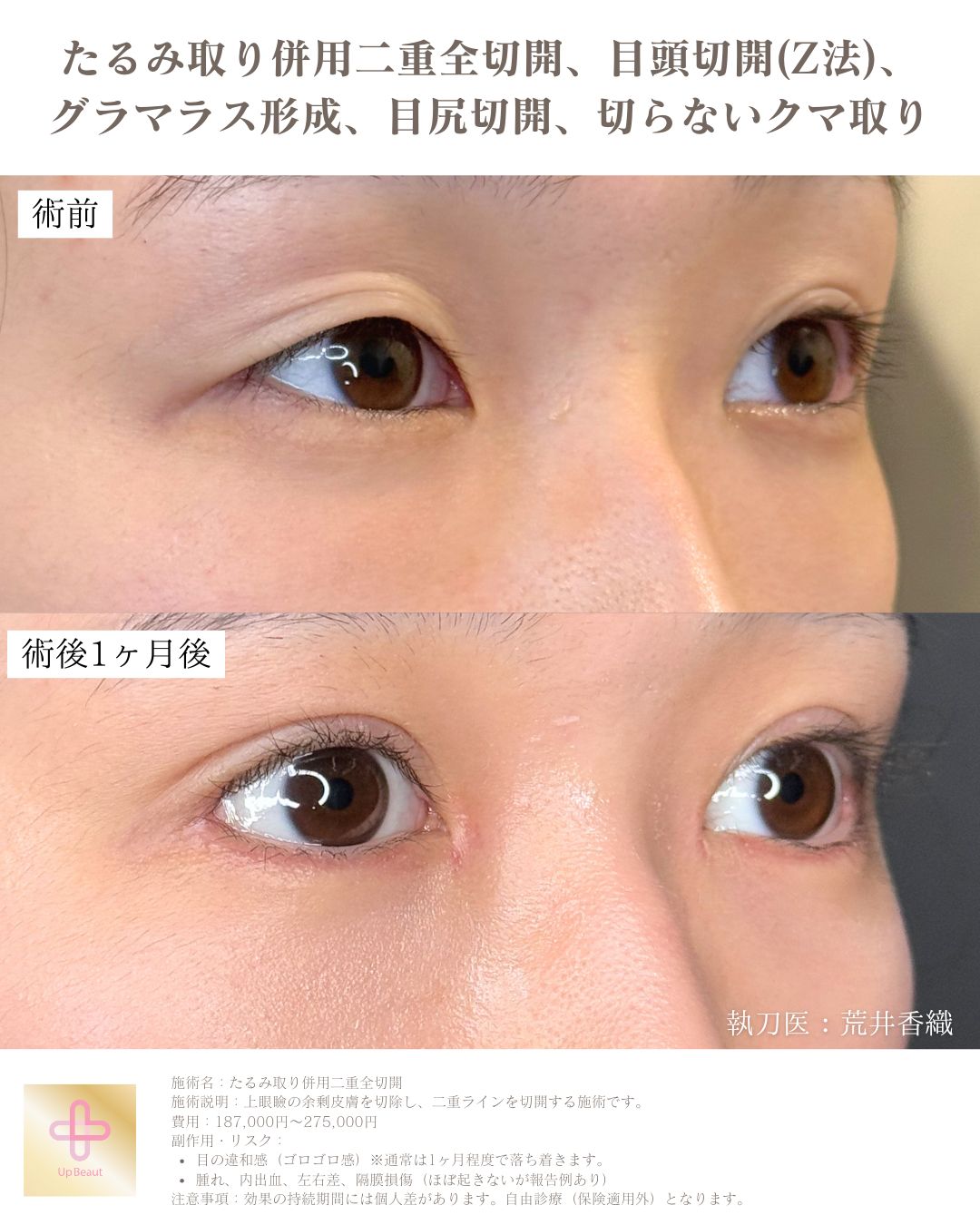 たるみ取り併用二重全切開、目頭切開(Z法) 、グラマラス形成、目尻切開、切らないクマ取り