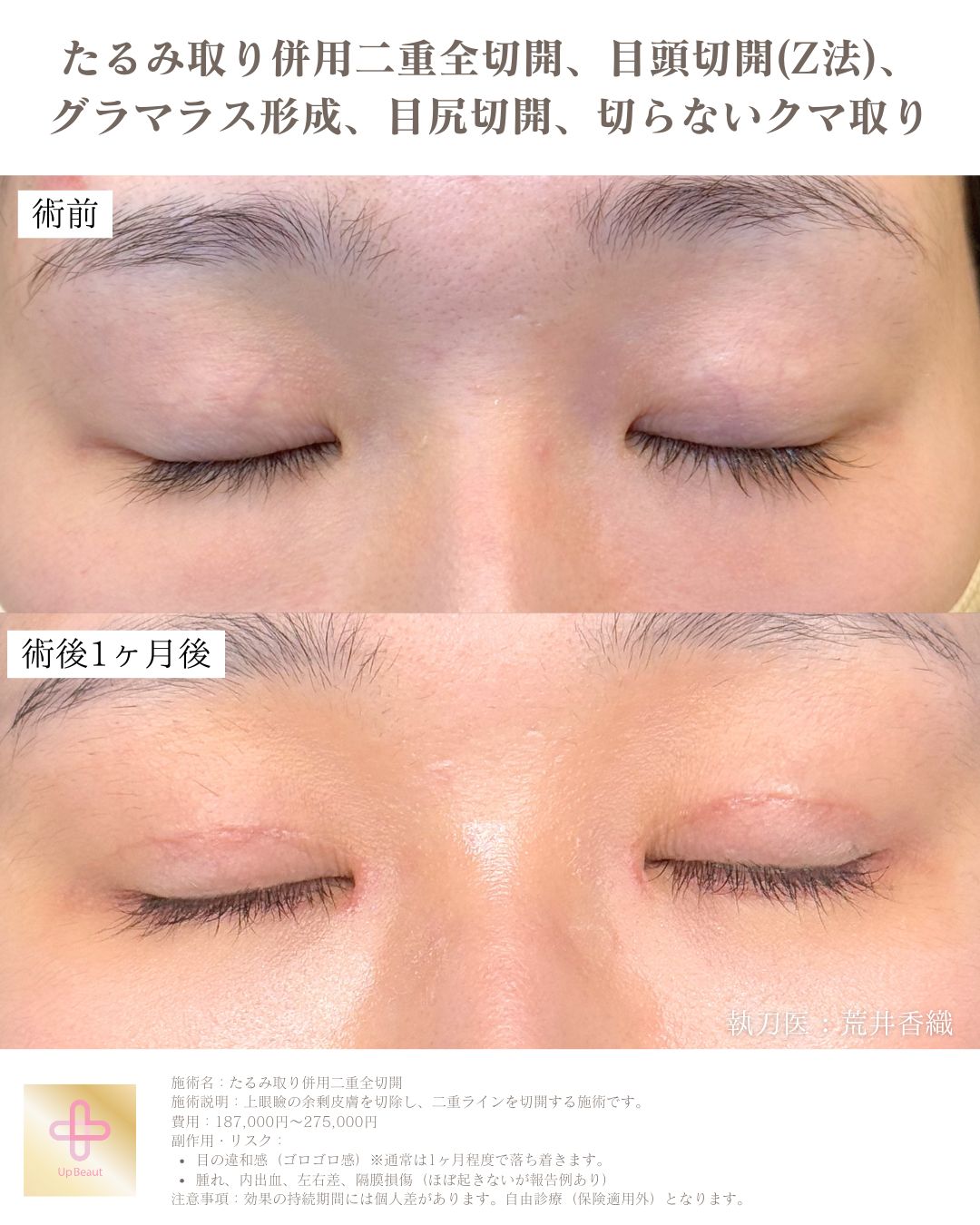 たるみ取り併用二重全切開、目頭切開(Z法) 、グラマラス形成、目尻切開、切らないクマ取り