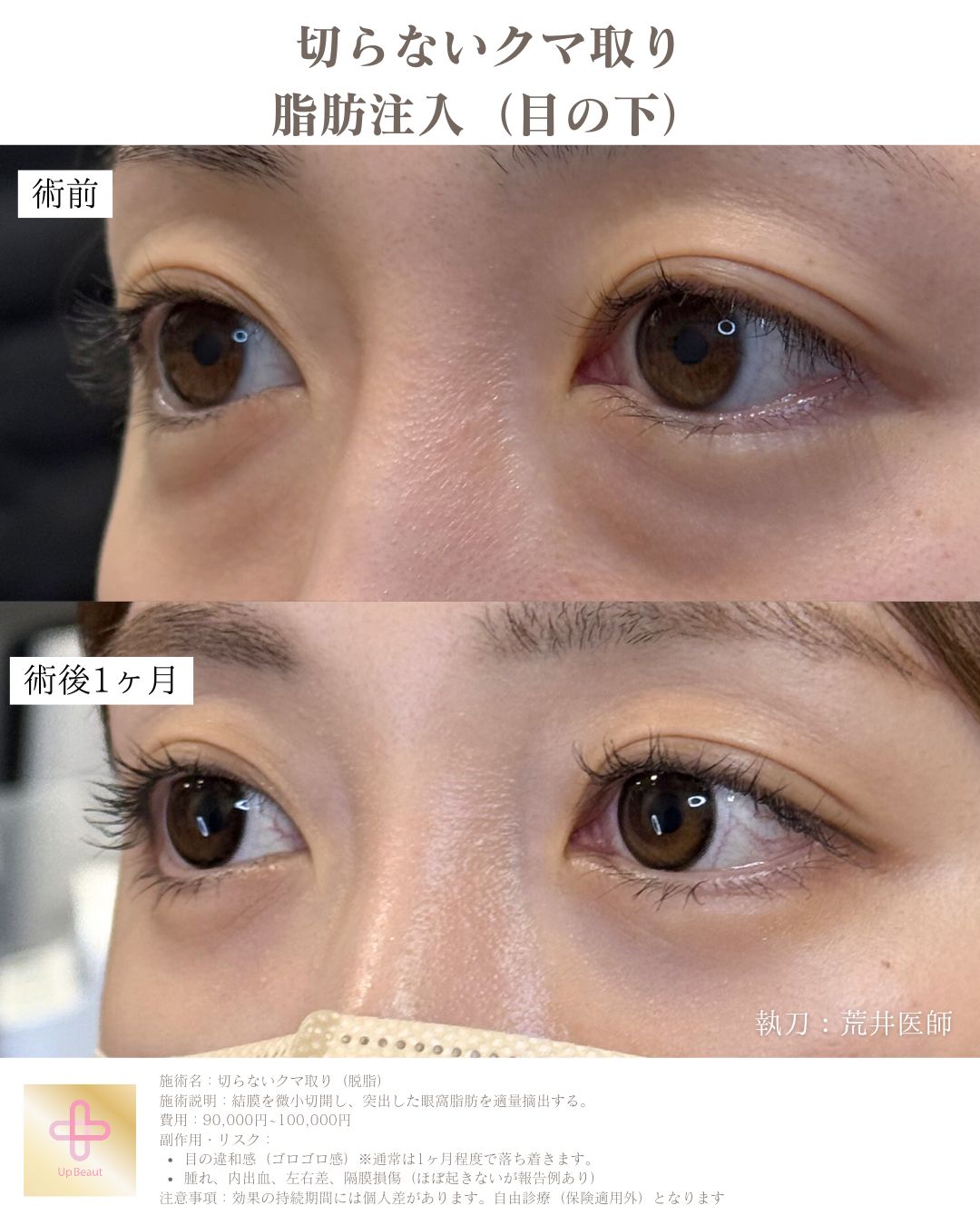 目の下の脱脂、脂肪注入（目の下）