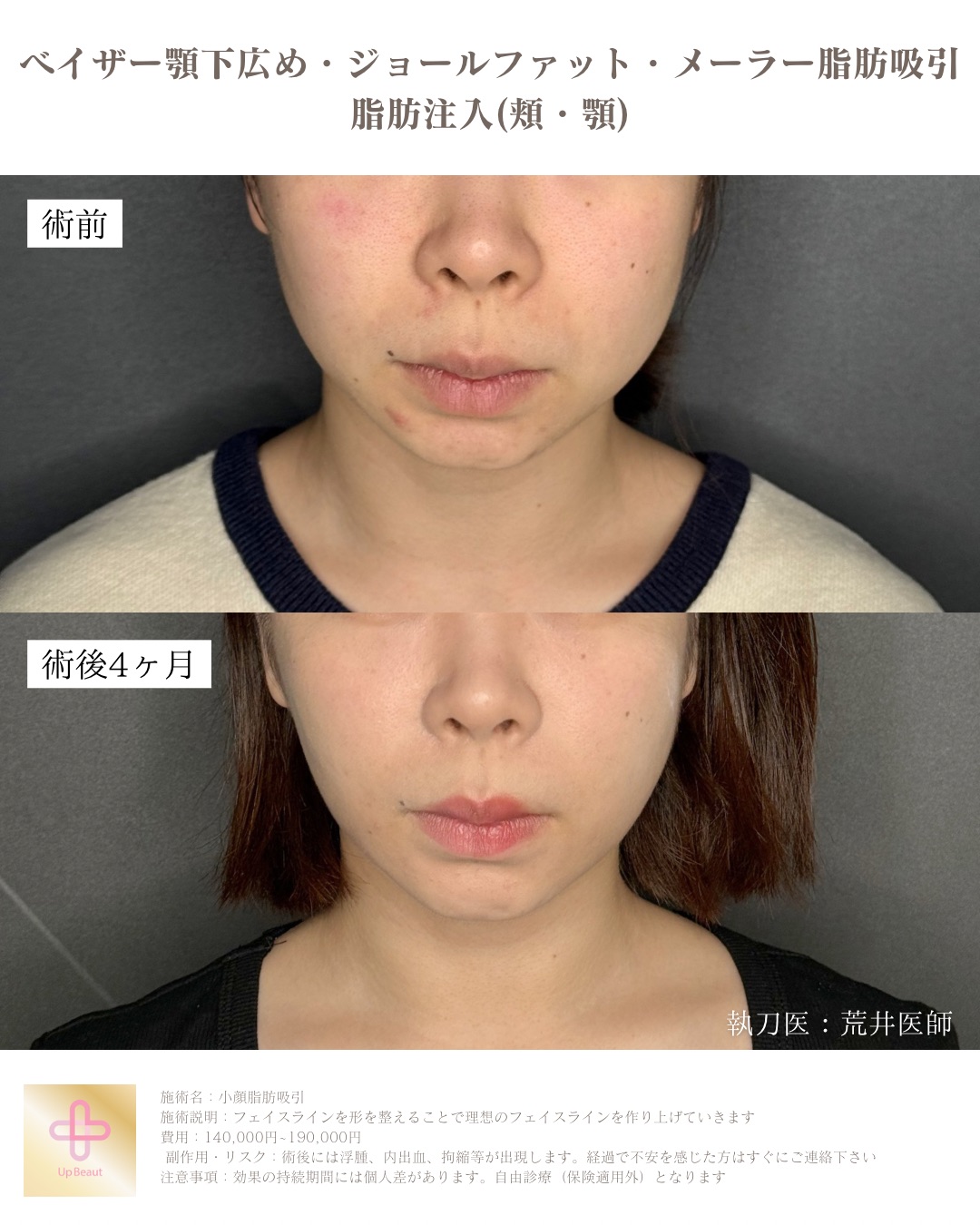 バッカル vs メーラー 解説図