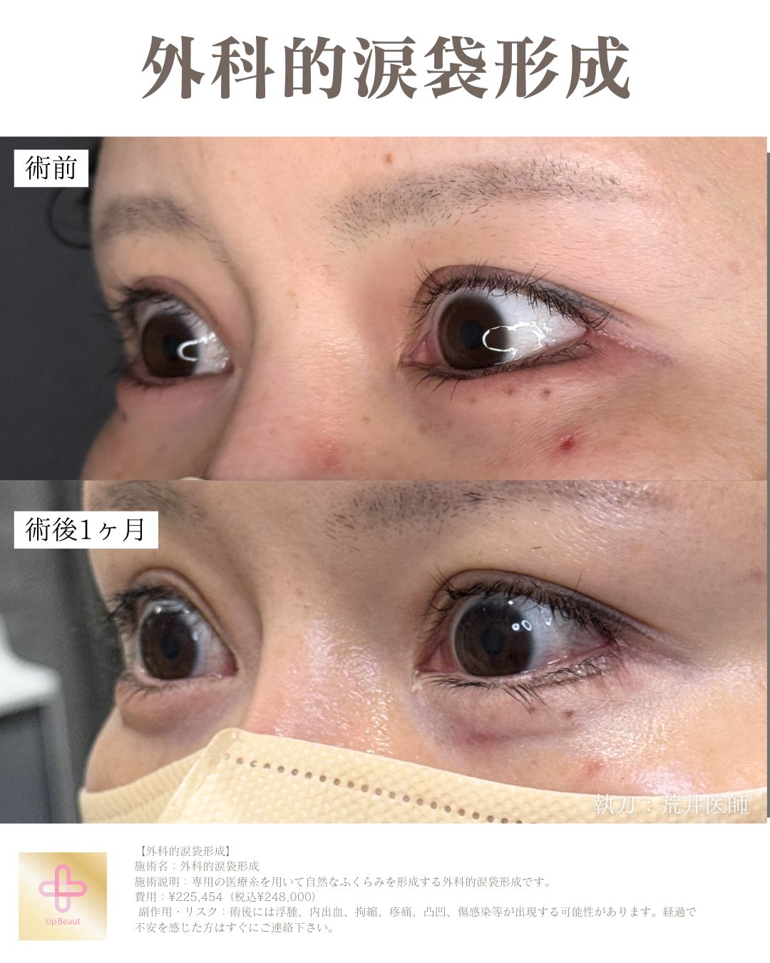 外科的涙袋形成