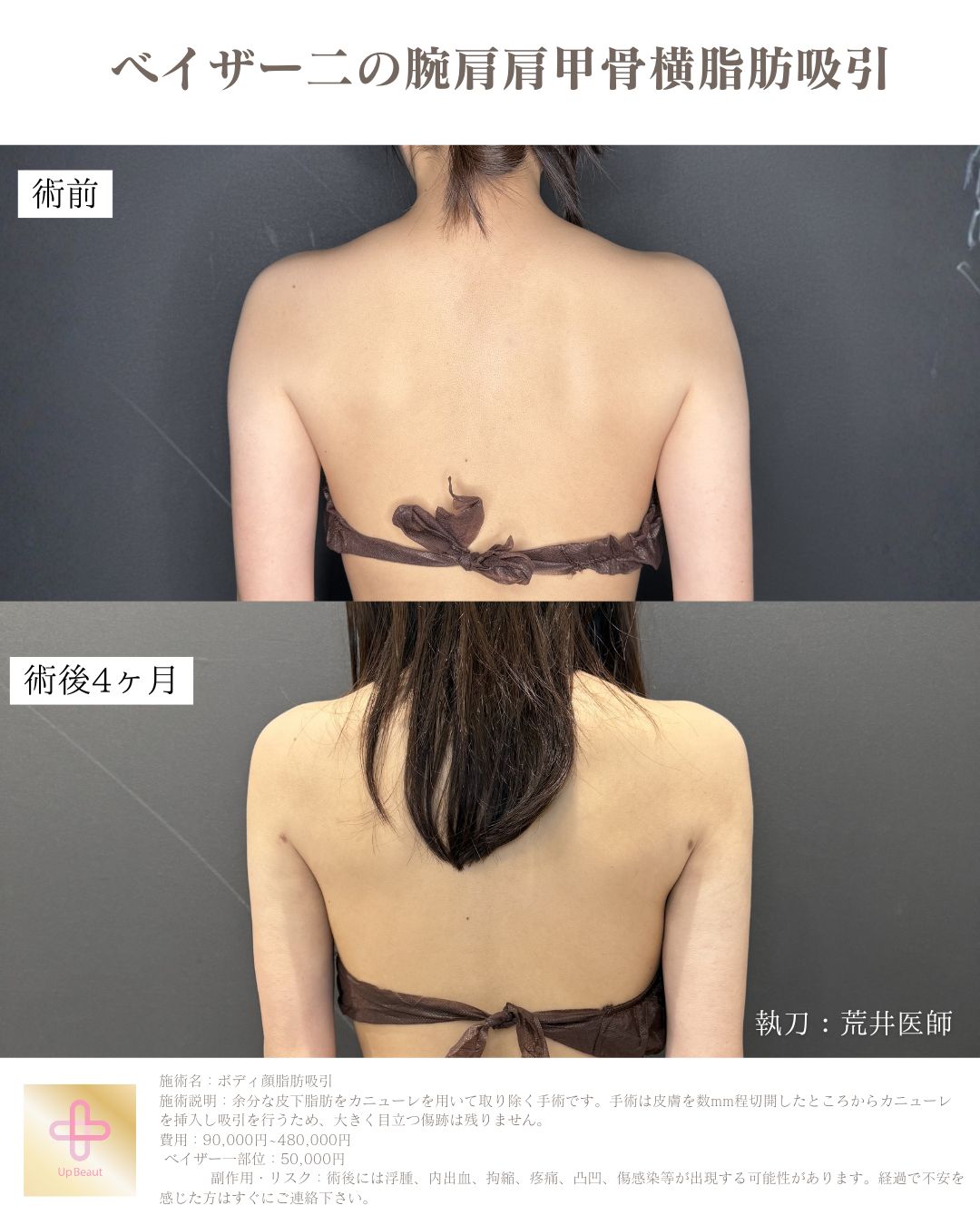 二の腕肩肩甲骨横脂肪吸引