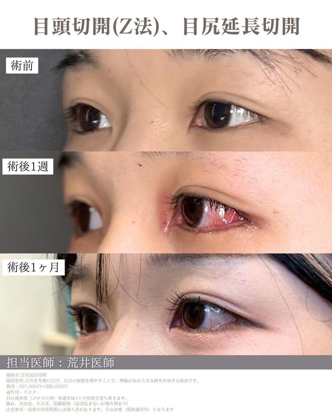 目尻延長切開症例