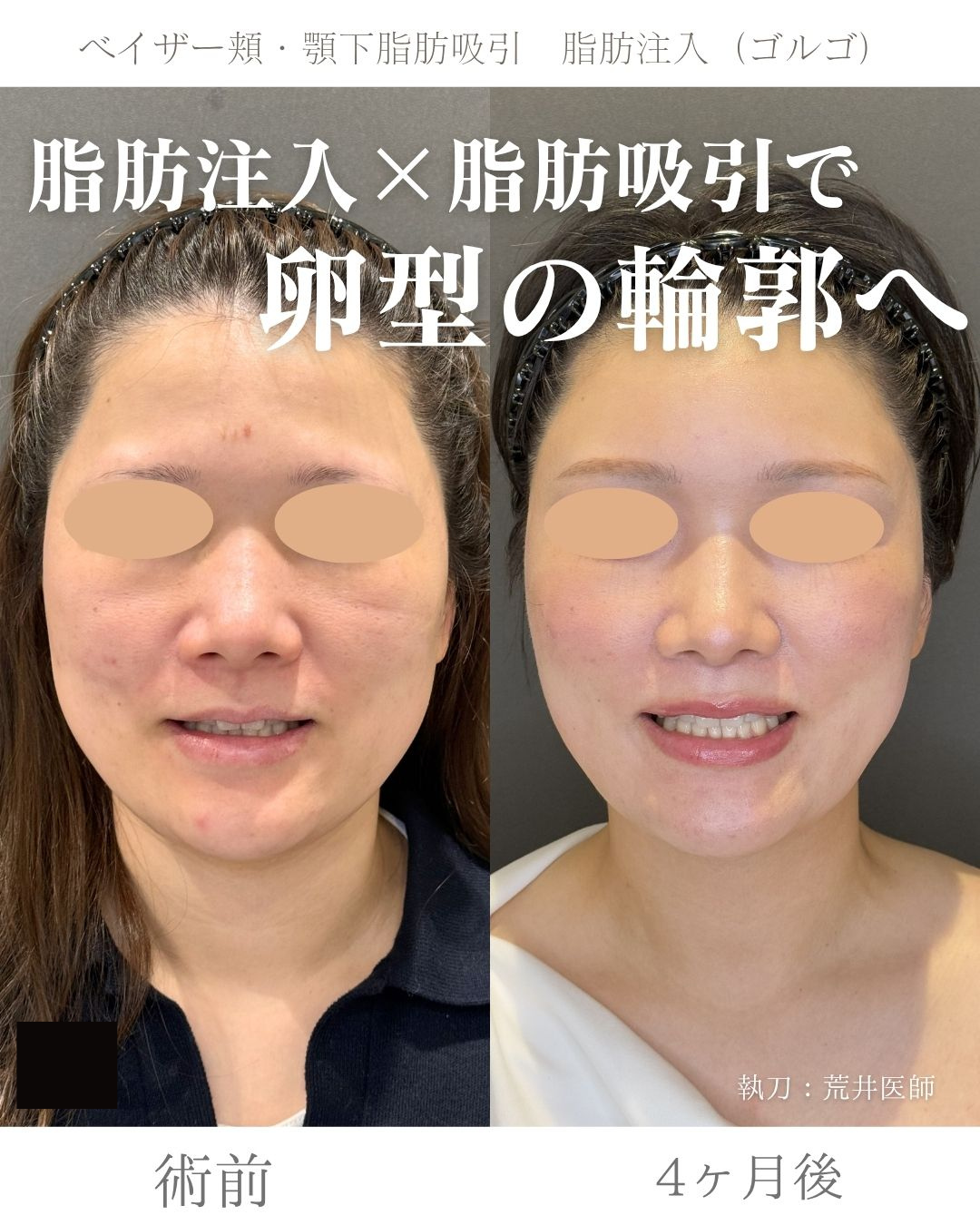 小顔脂肪吸引　脂肪注入