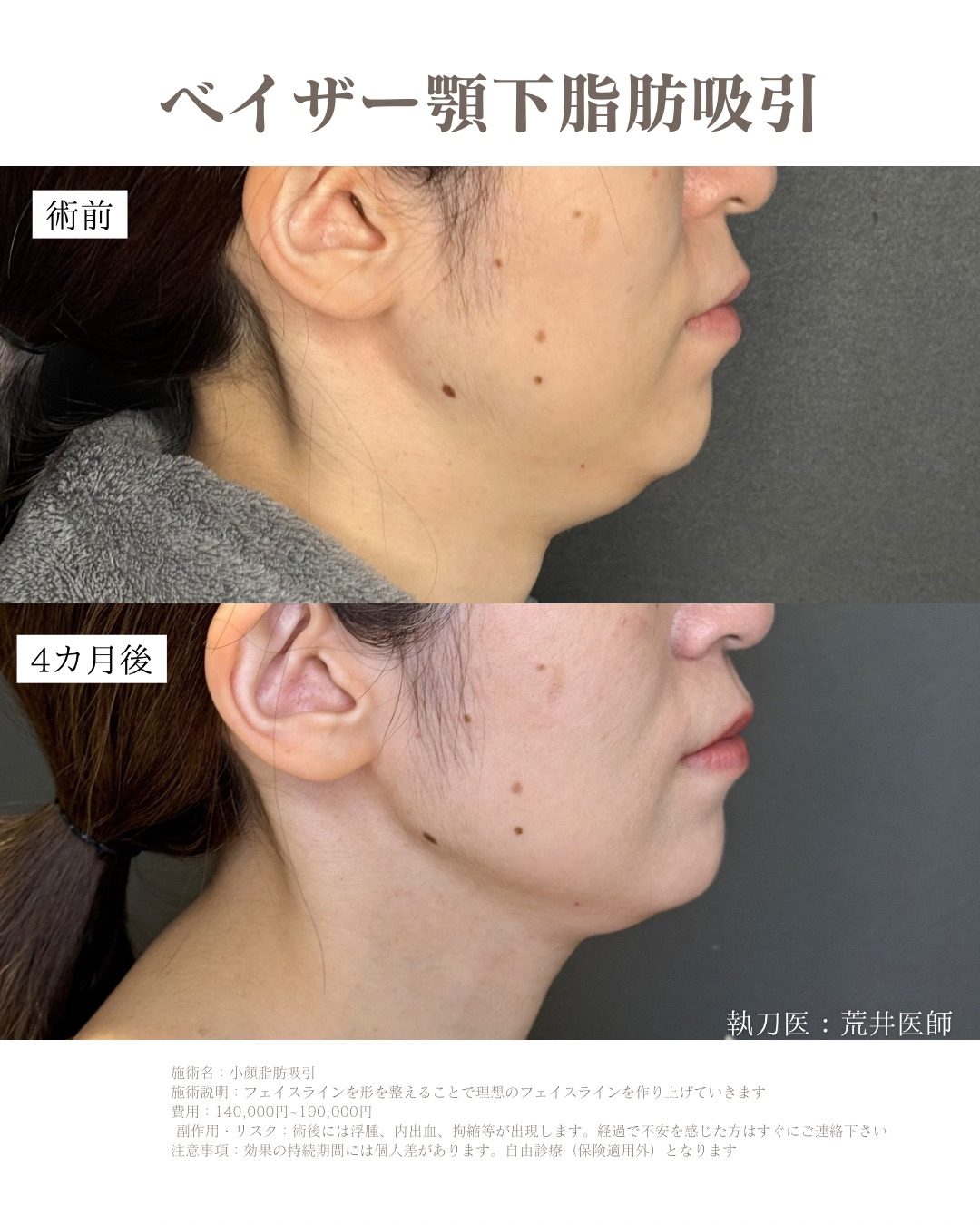 顎下脂肪吸引