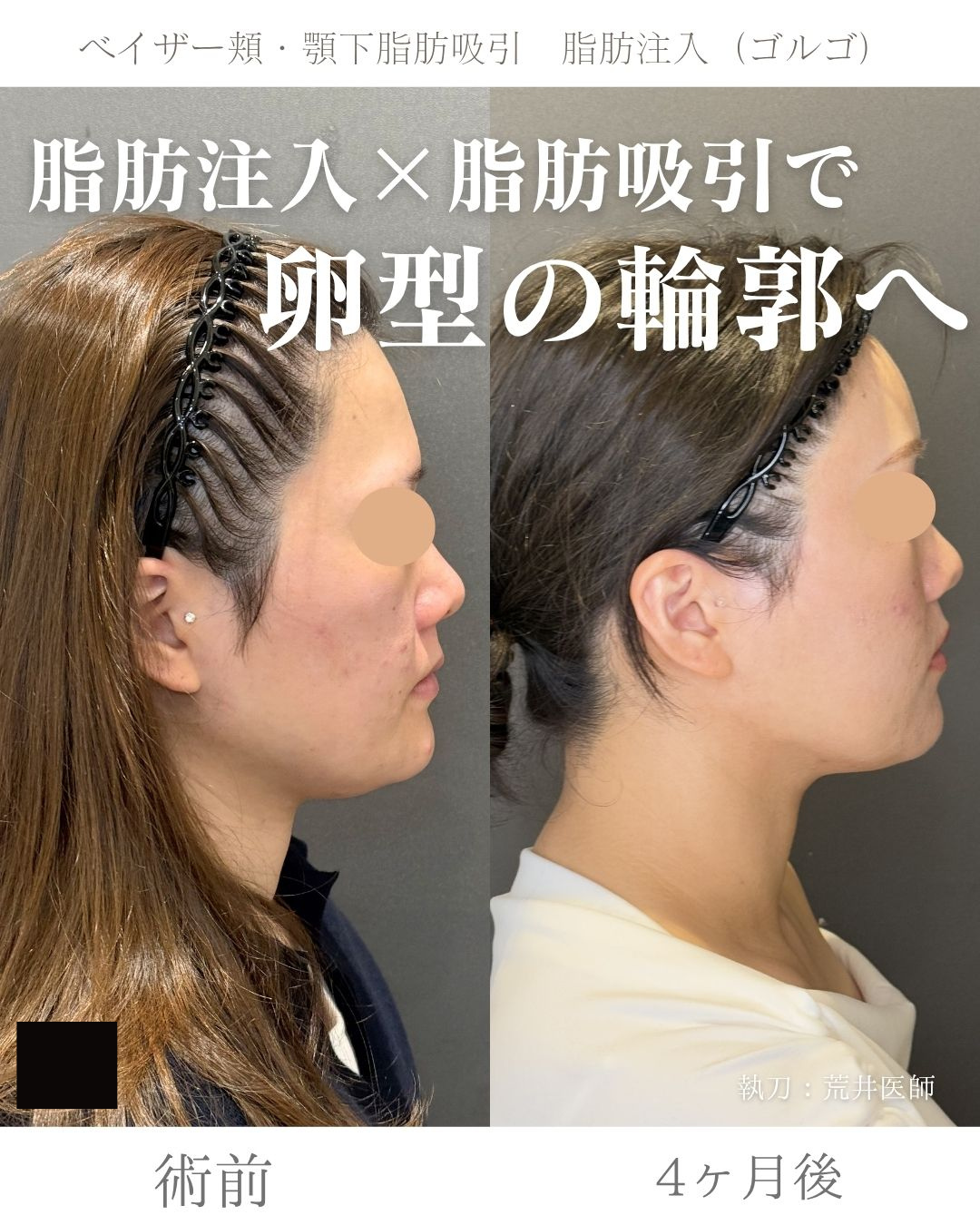 小顔脂肪吸引　脂肪注入
