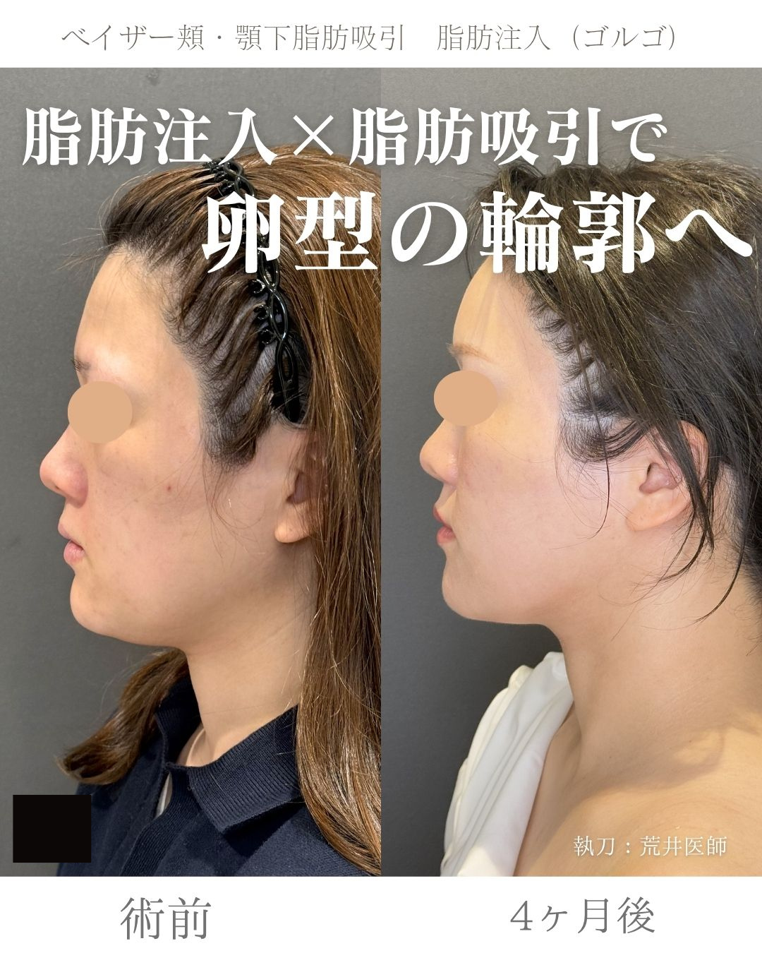 小顔脂肪吸引　脂肪注入