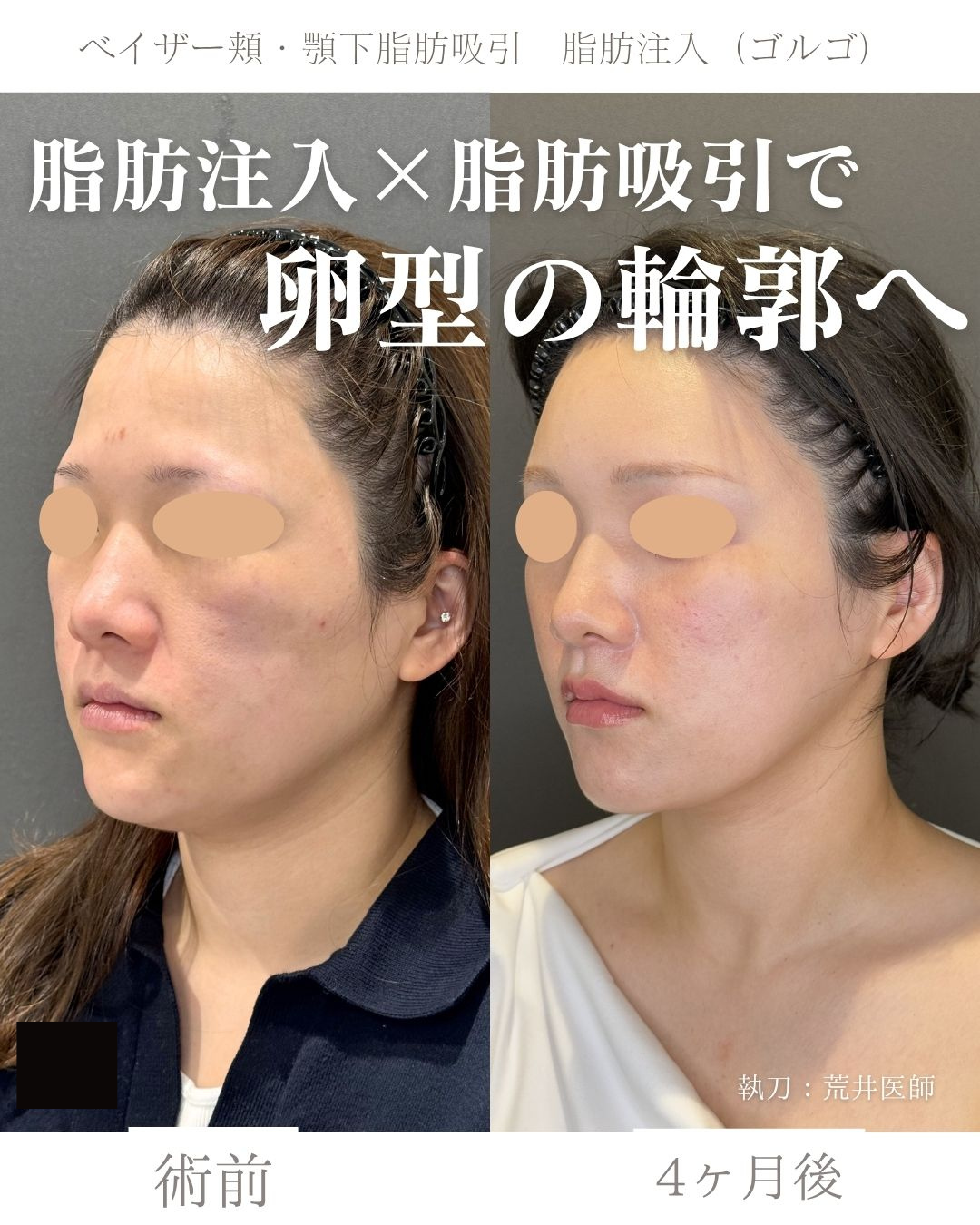 小顔脂肪吸引　脂肪注入