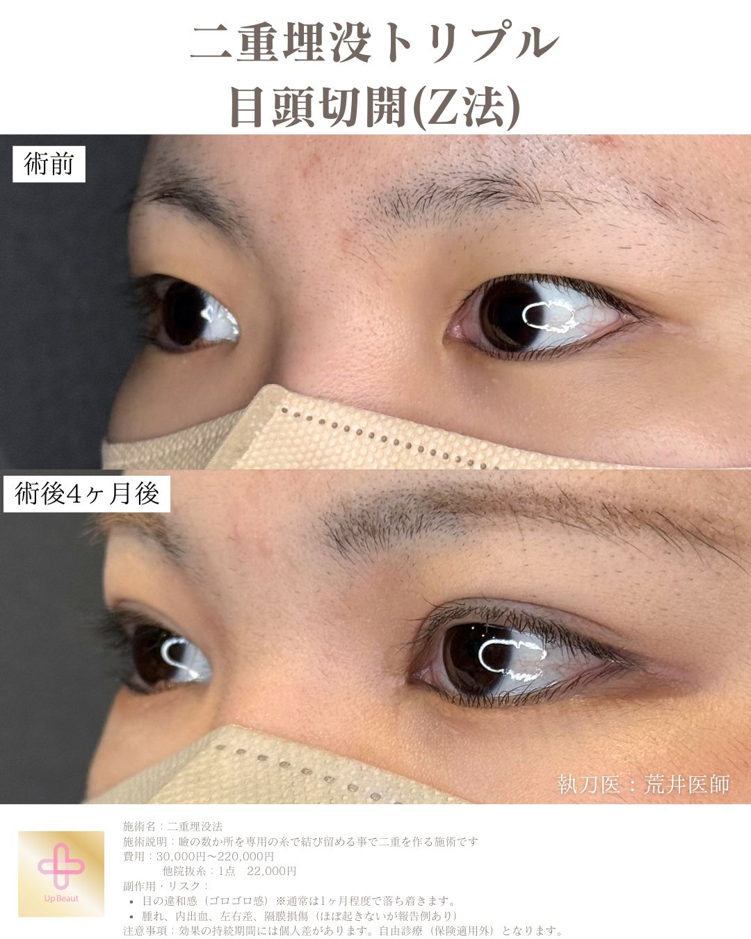 二重埋没法 3点留め 症例3