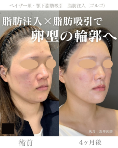 小顔脂肪吸引　脂肪注入