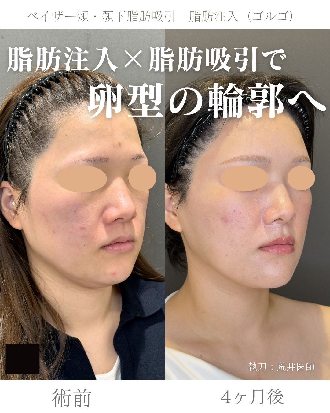 小顔脂肪吸引　脂肪注入