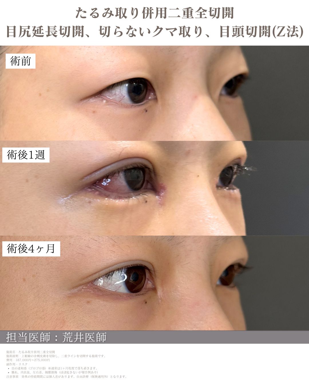 目尻延長切開　症例写真