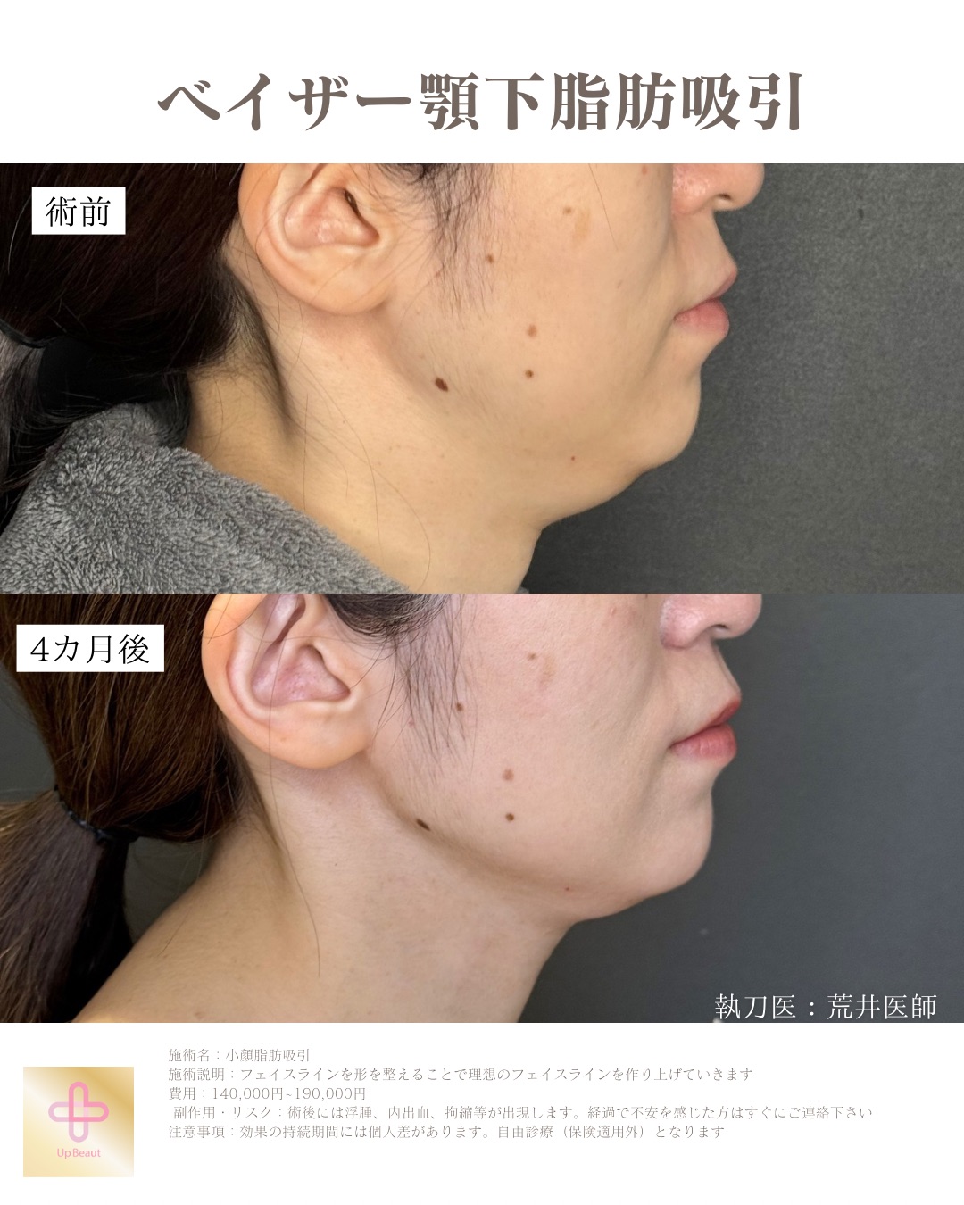 顎下広め脂肪吸引