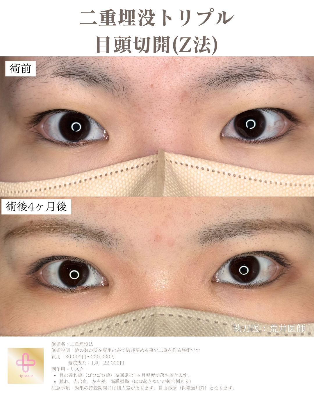 二重埋没法 3点留め 症例1