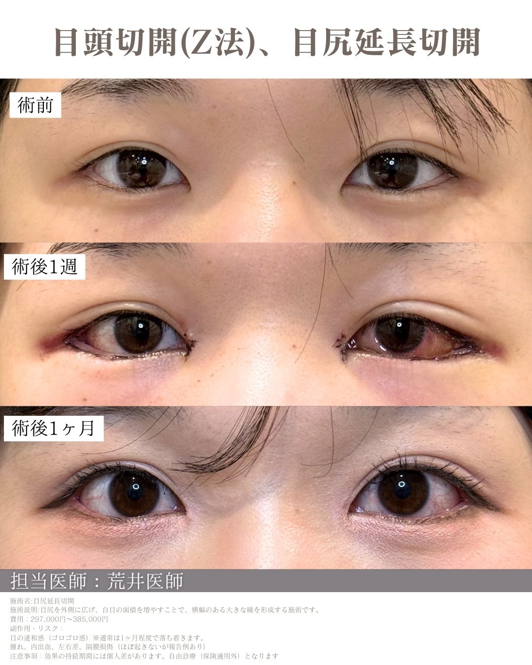 目尻延長切開の症例写真(ビフォーアフター)