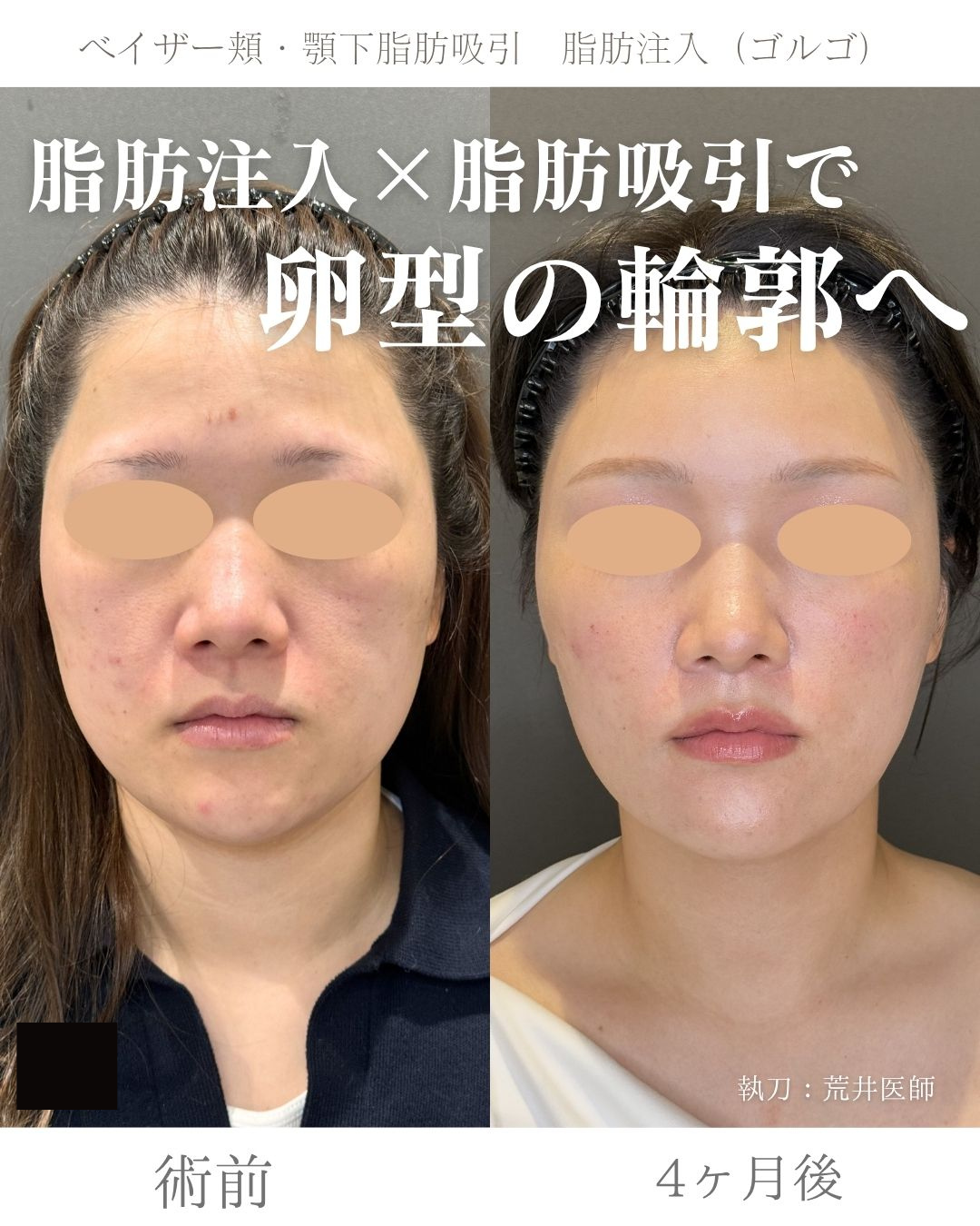 小顔脂肪吸引、ゴルゴ脂肪注入