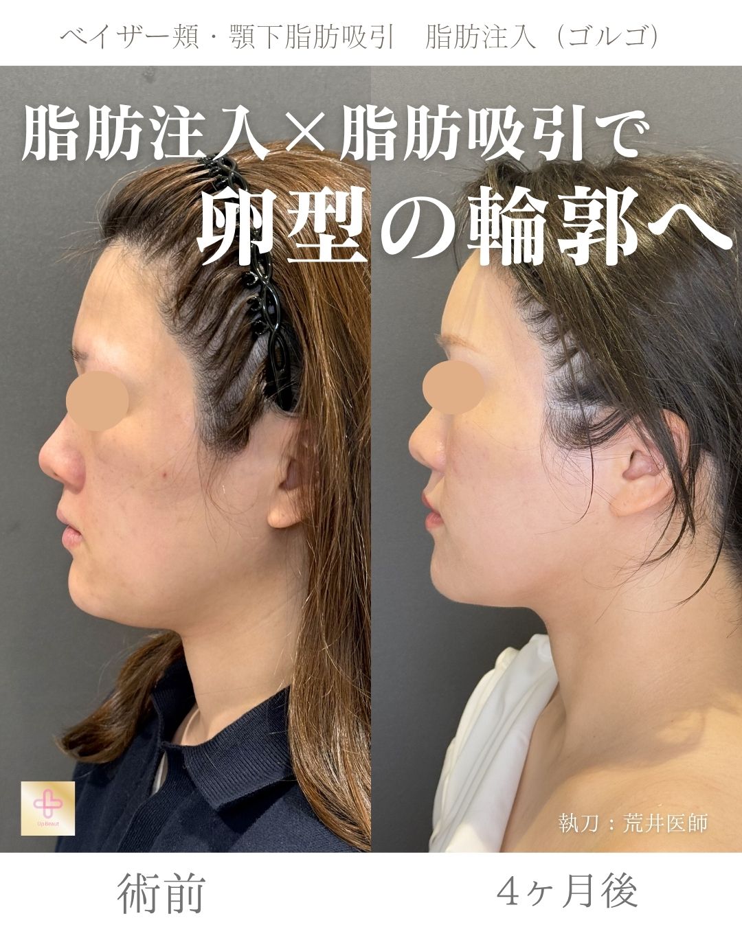 小顔脂肪吸引、ゴルゴ脂肪注入