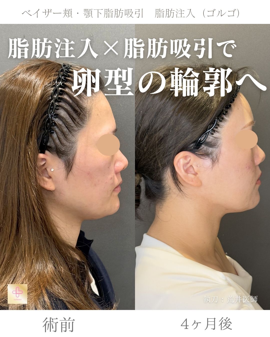 小顔脂肪吸引、ゴルゴ脂肪注入
