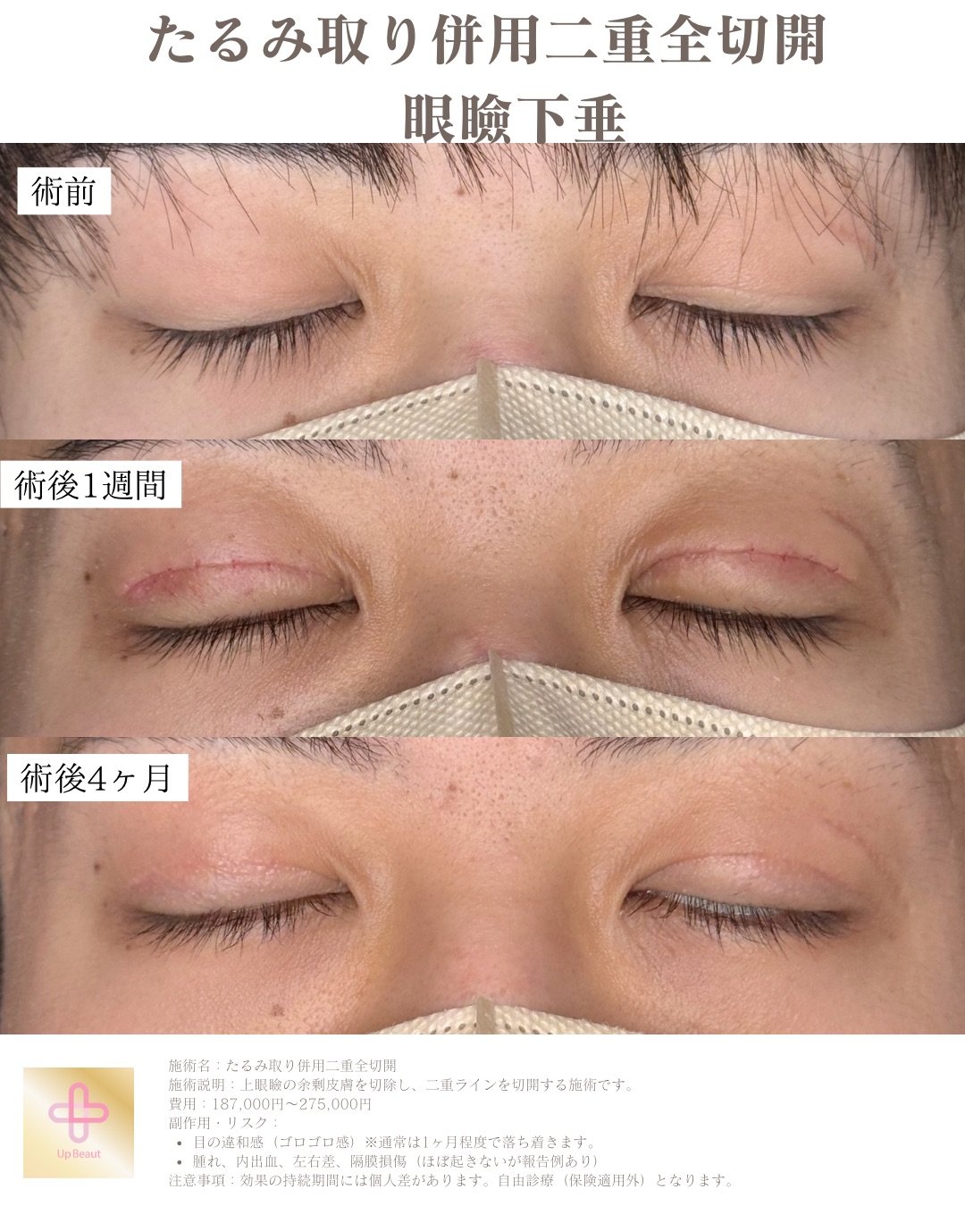 二重整形　眼瞼下垂　男性ビフォーアフター症例写真