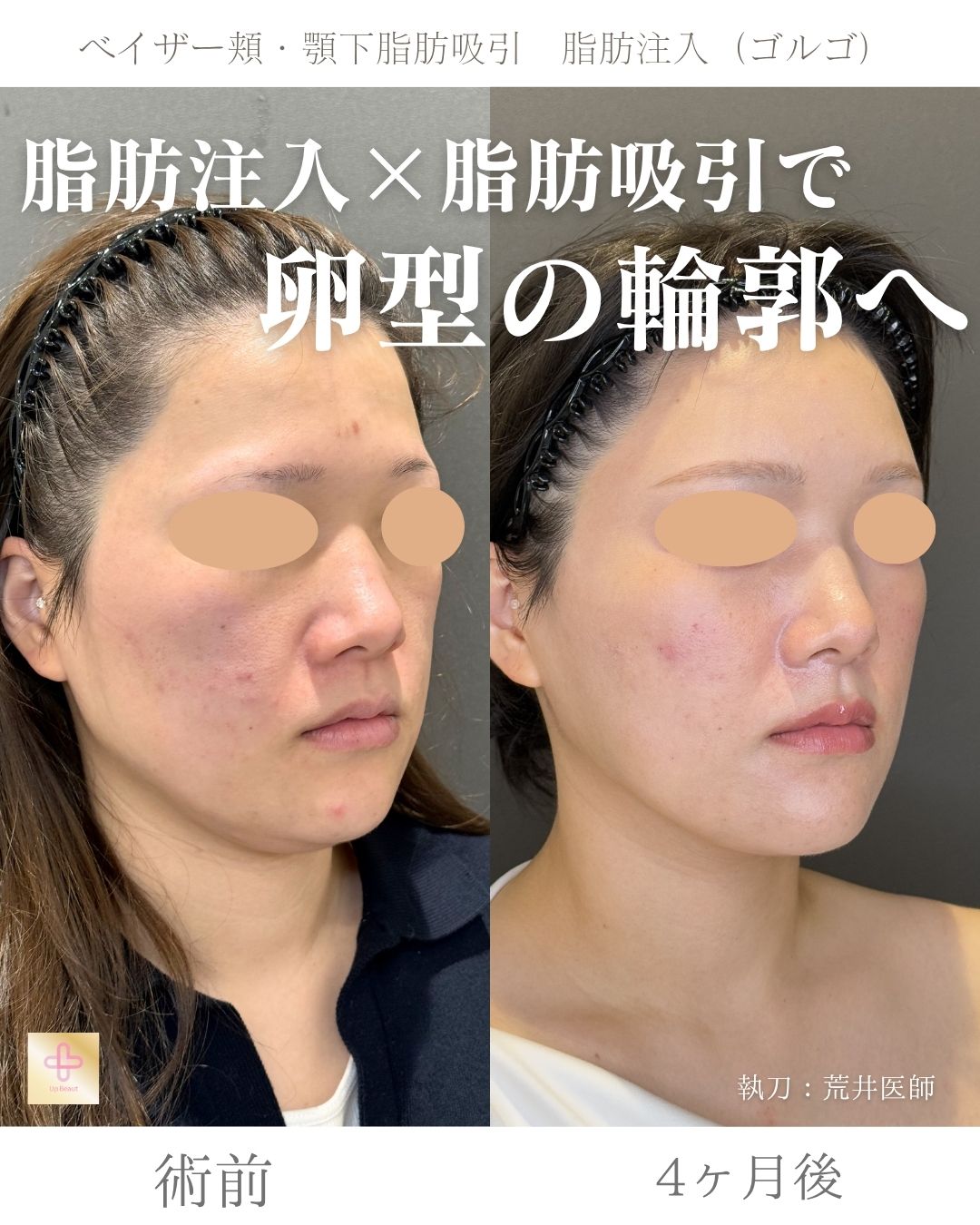 脂肪吸引と脂肪注入