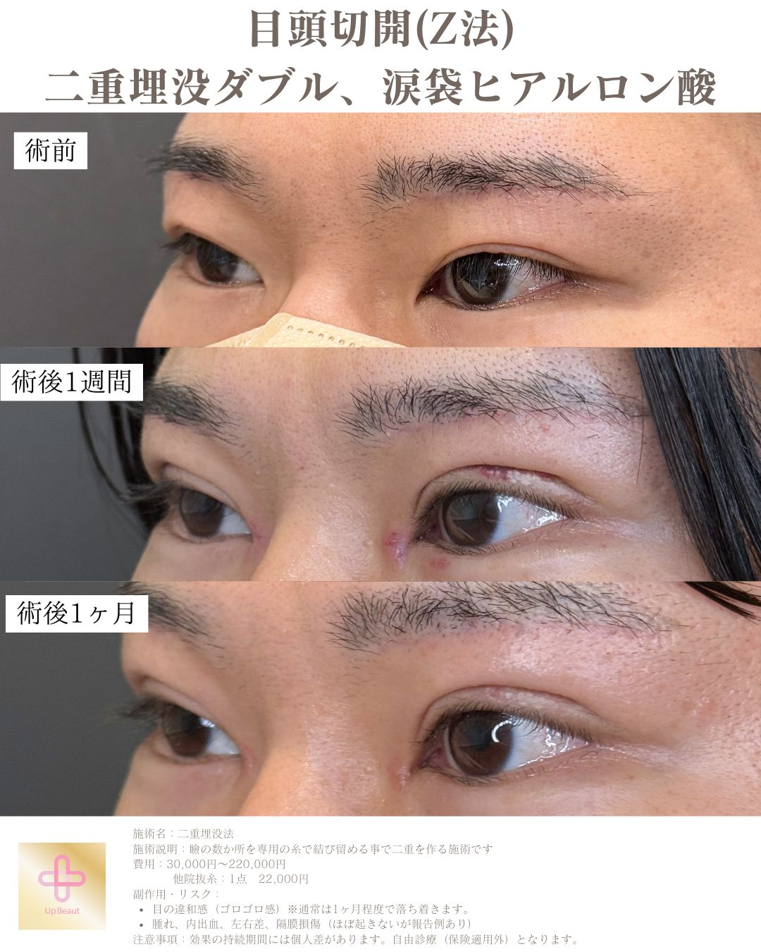 二重埋没法 2点留め 症例3