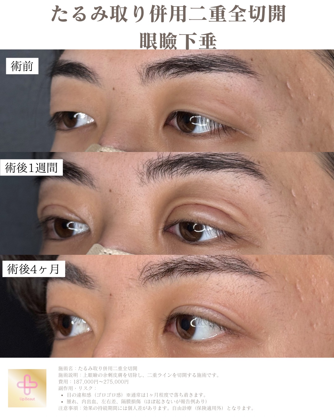 二重整形　眼瞼下垂　男性ビフォーアフター症例写真