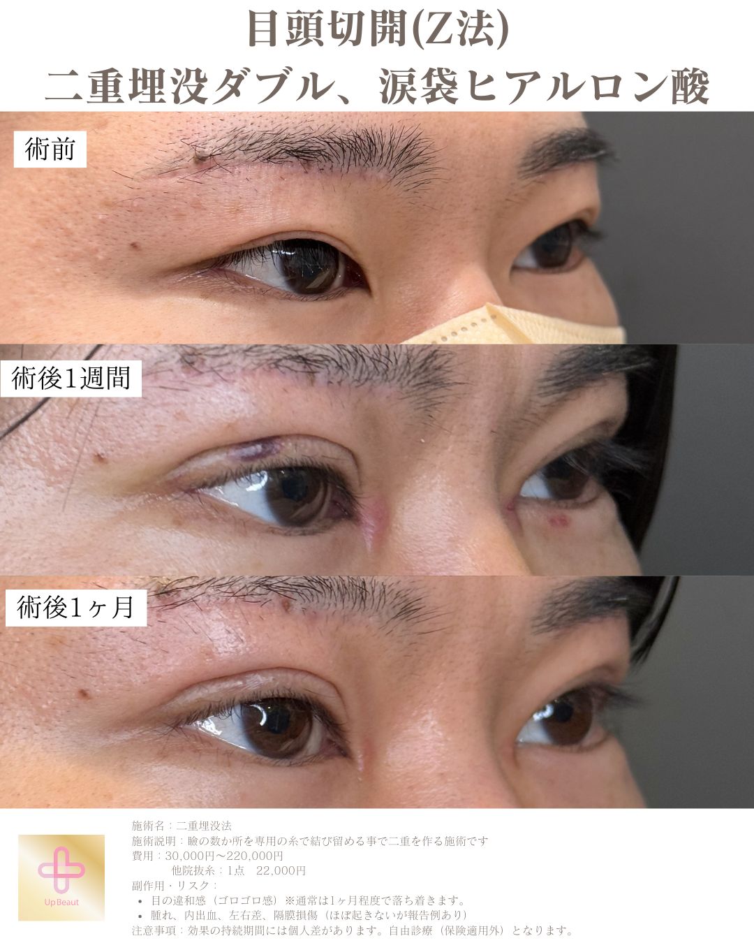 二重埋没法 2点留め 症例2