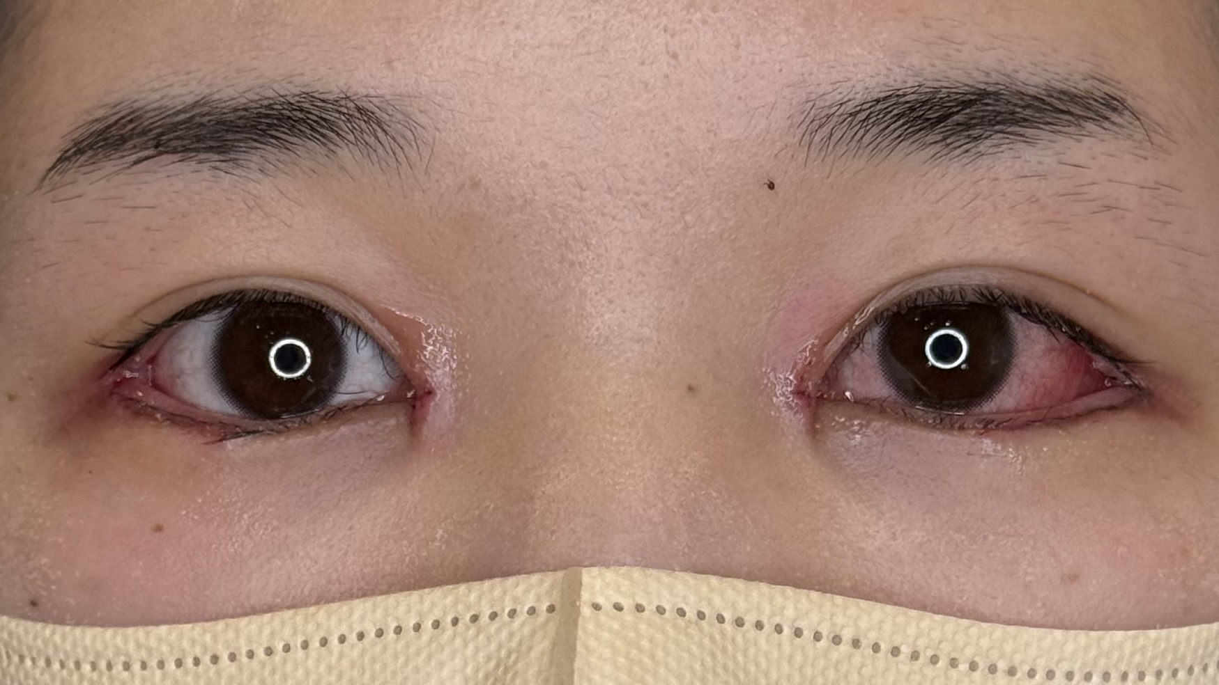 目尻延長切開 抜糸直後