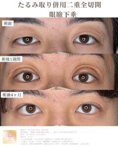 二重整形　眼瞼下垂　男性ビフォーアフタ症例写ー症例写真