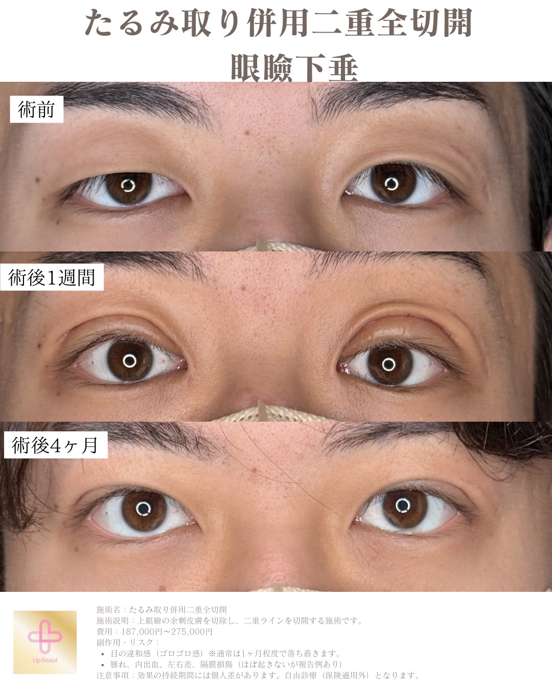 二重整形　眼瞼下垂　男性ビフォーアフタ症例写ー症例写真