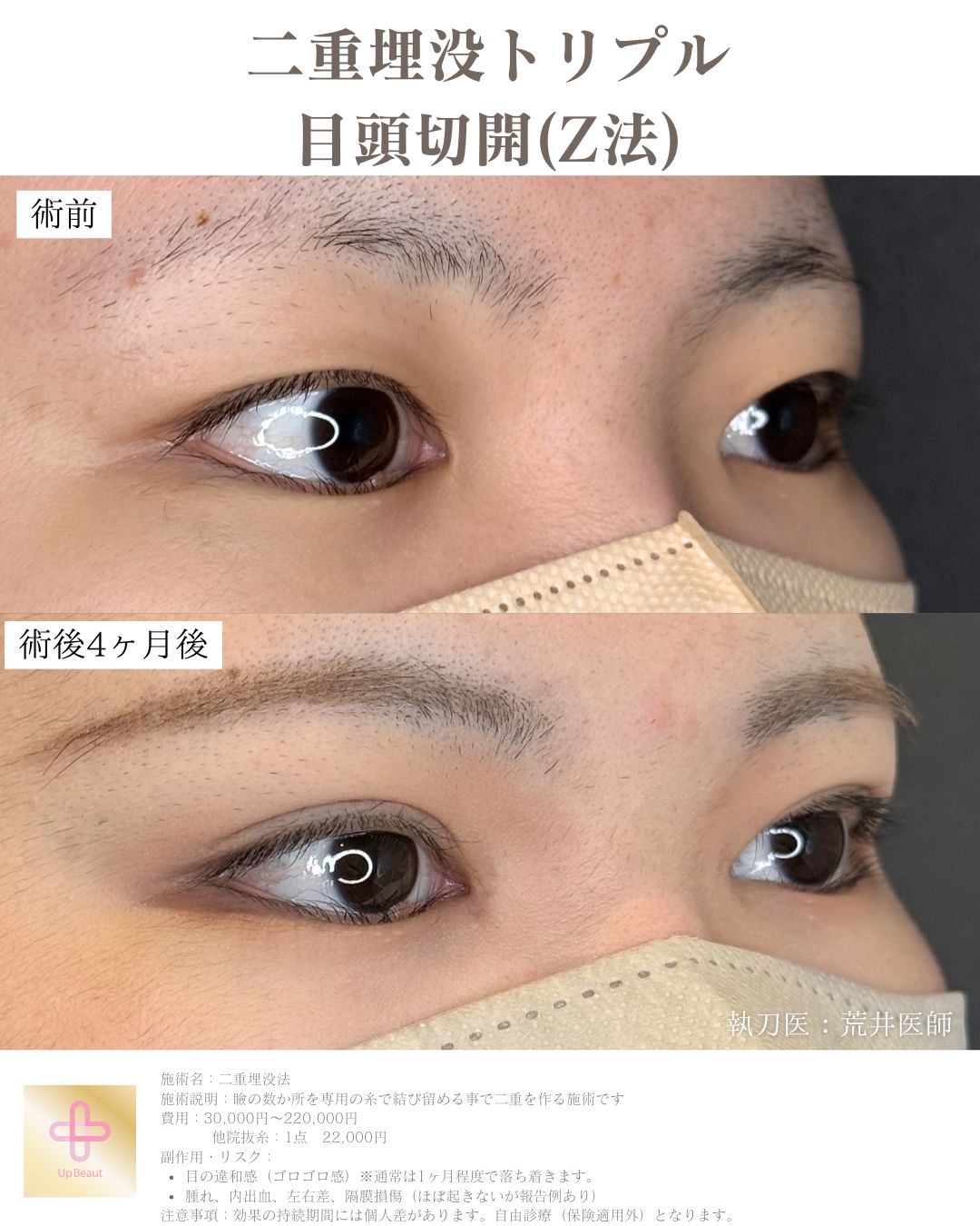 二重埋没法 3点留め 症例2