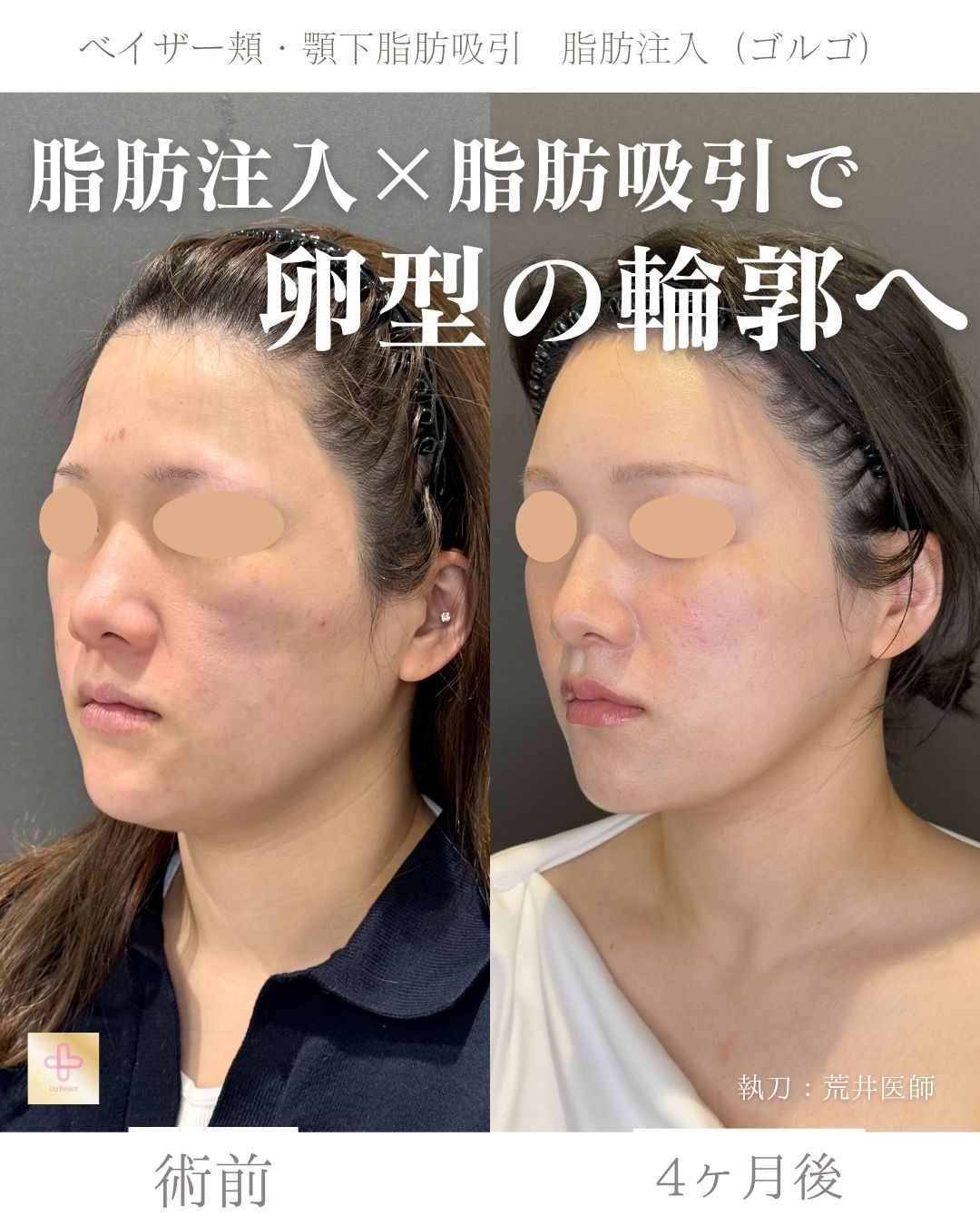 脂肪吸引と脂肪注入