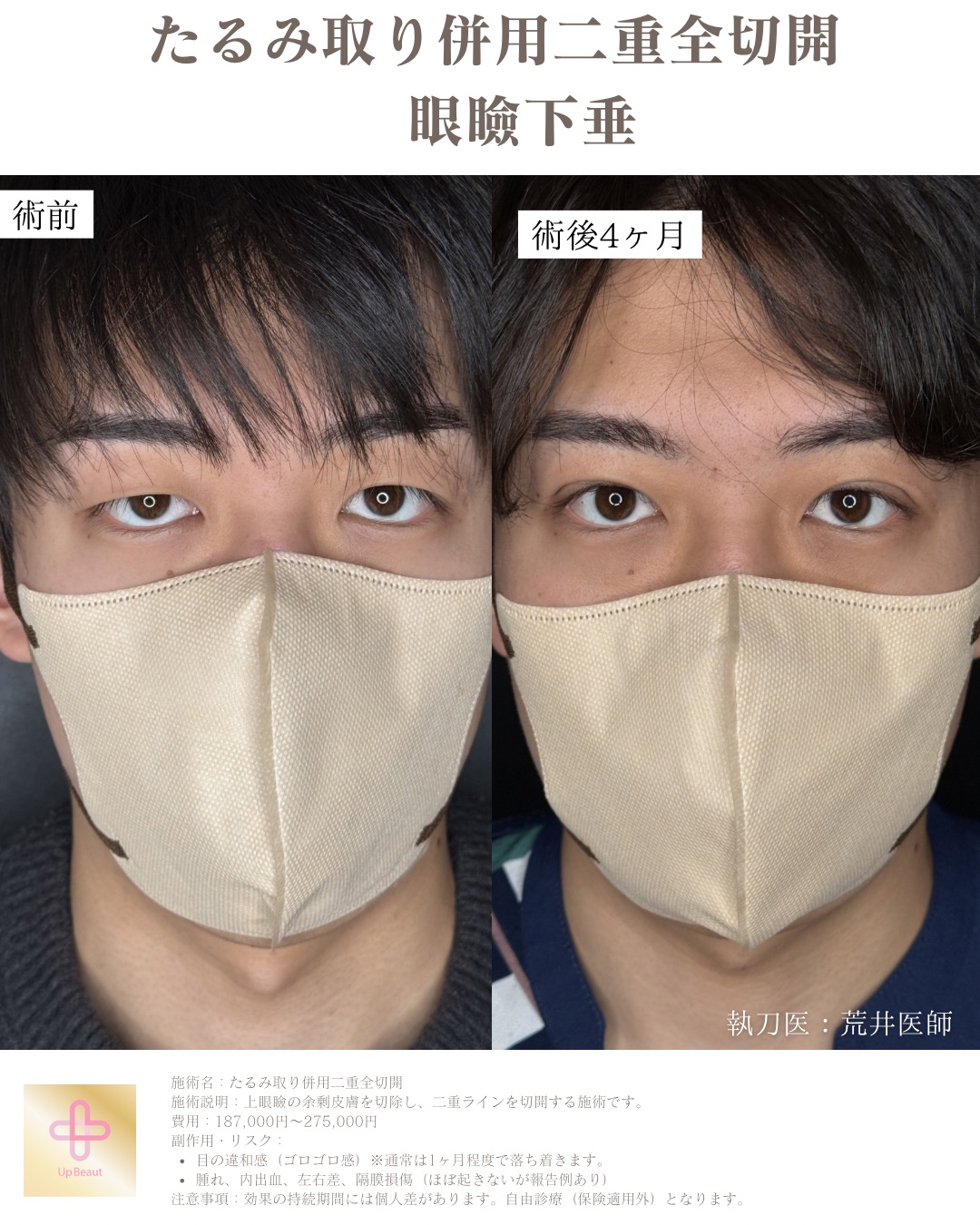 二重整形　眼瞼下垂　男性ビフォーアフター症例写真
